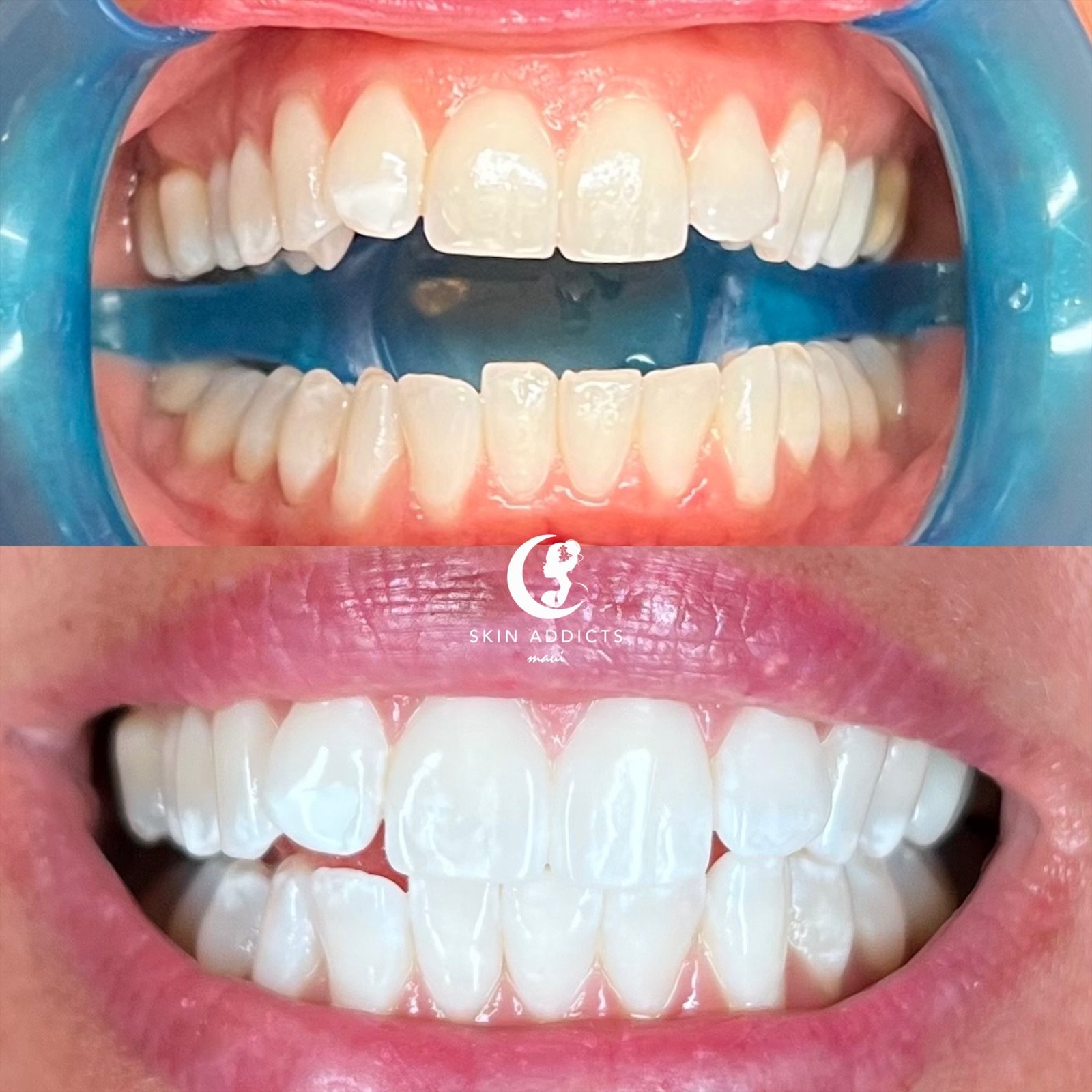 Comparison of teeth before and after dental whitening treatment, showing brighter, whiter teeth in the lower image.