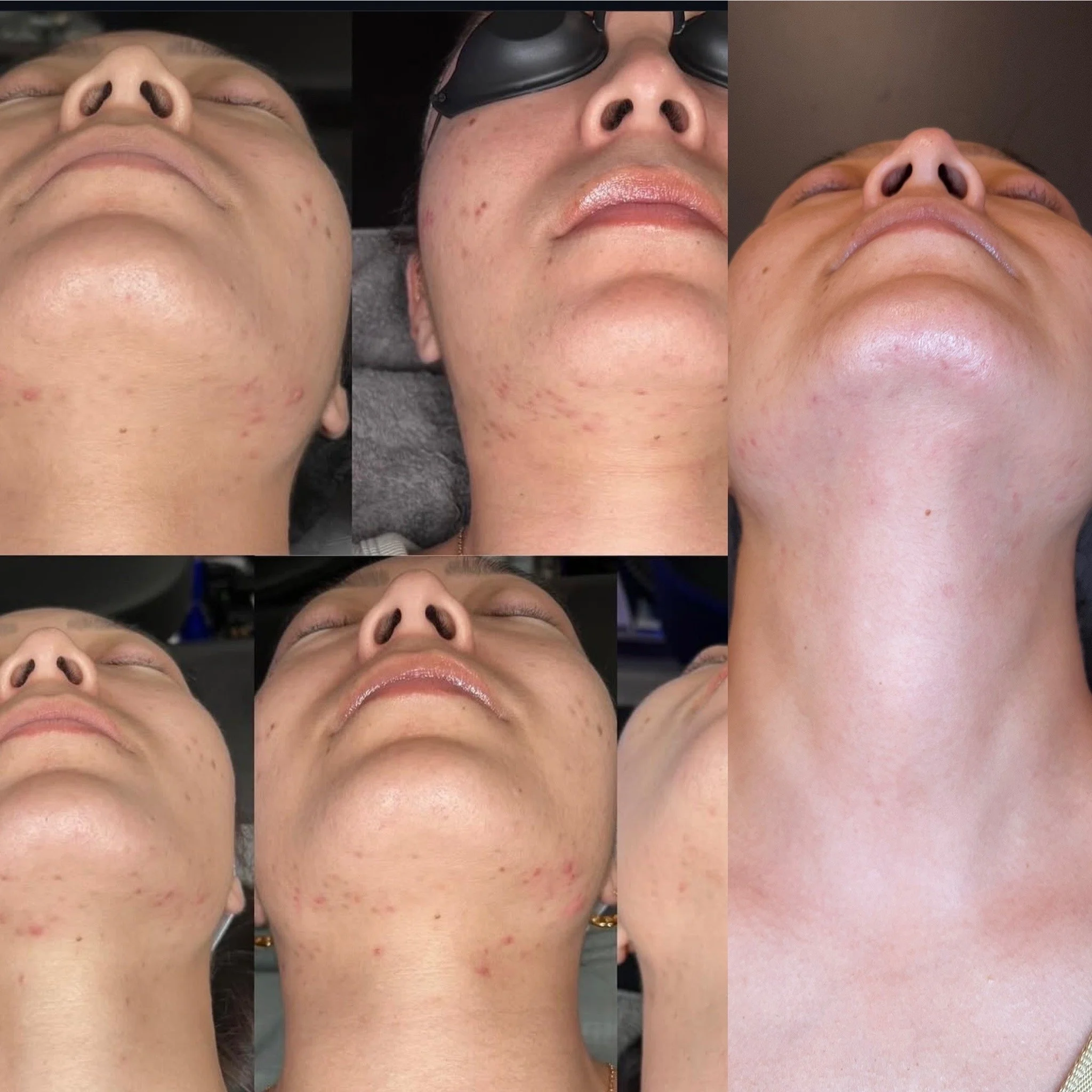facial