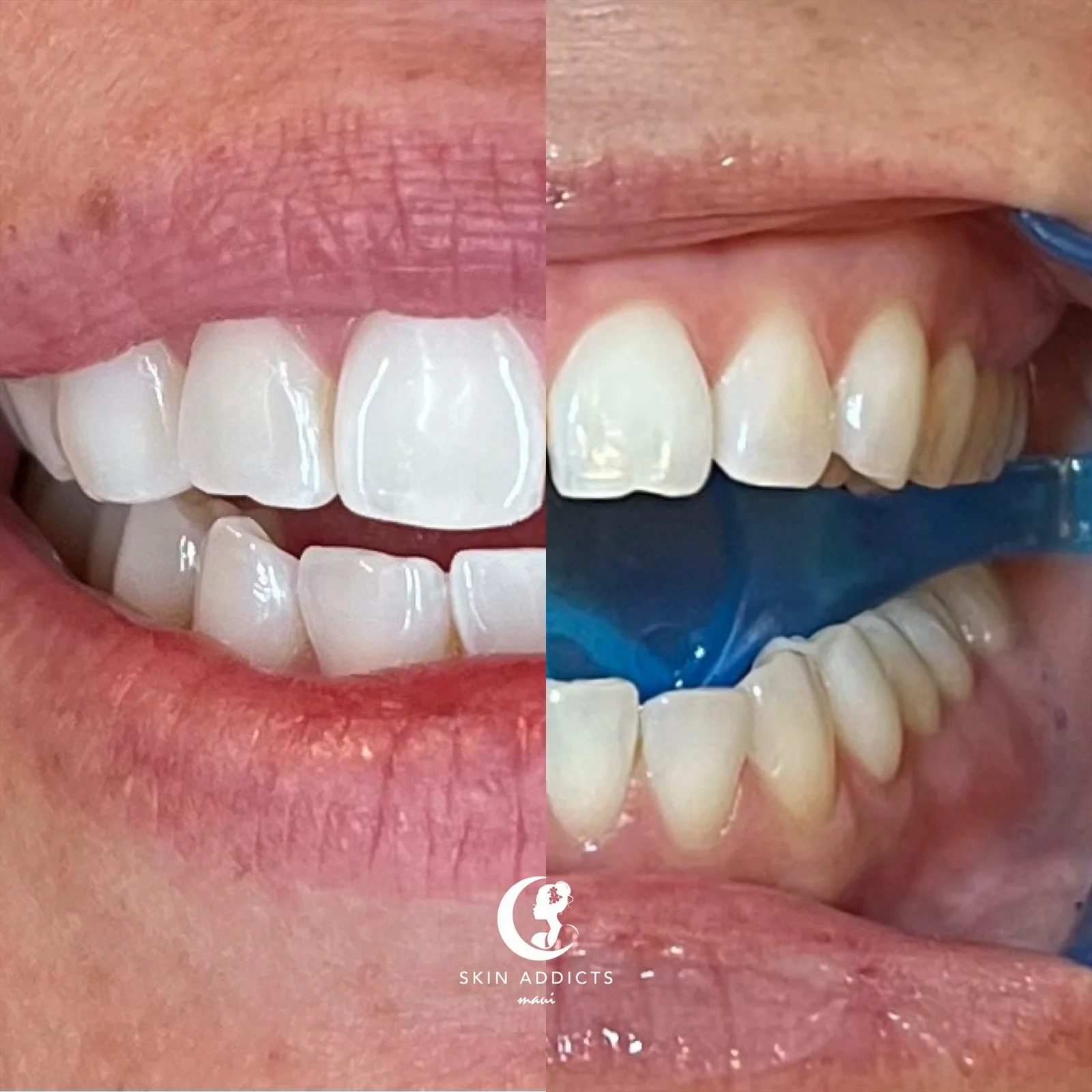 Close-up of a person's teeth, showing a before and after comparison of dental whitening. The left side displays whiter teeth, and the right side shows natural, slightly darker teeth. The person's mouth is open, showing upper and lower teeth.