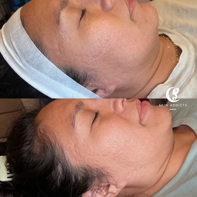 Close-up of a woman's face before and after a skin treatment, showing significant improvement in skin texture and clarity.