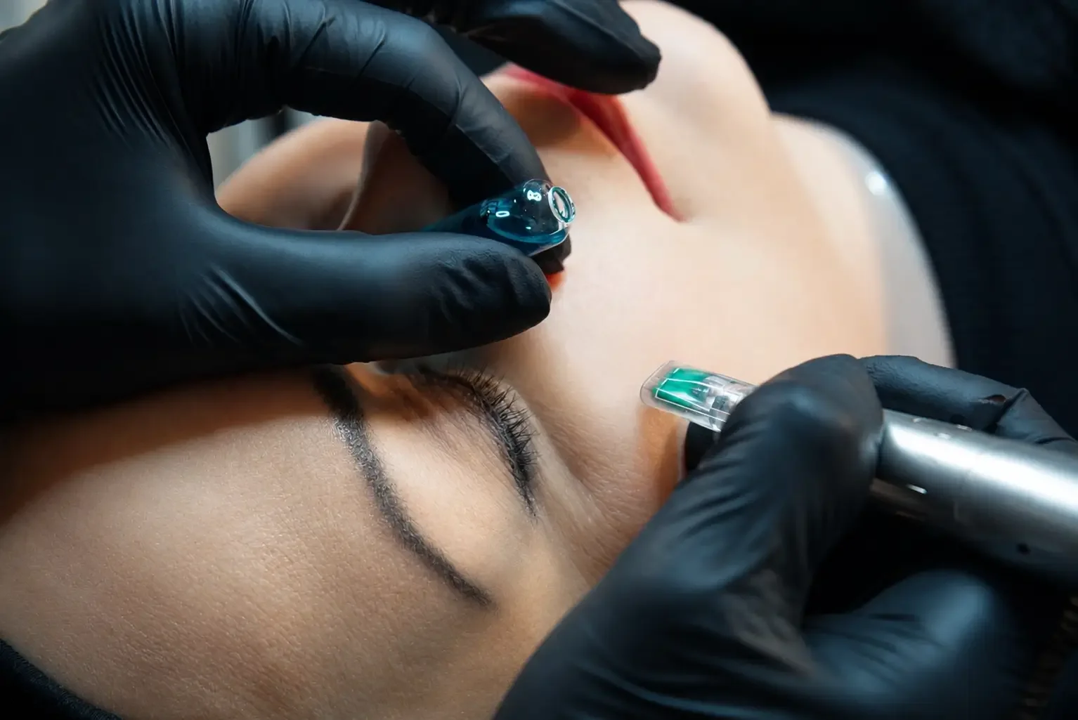 Microneedling