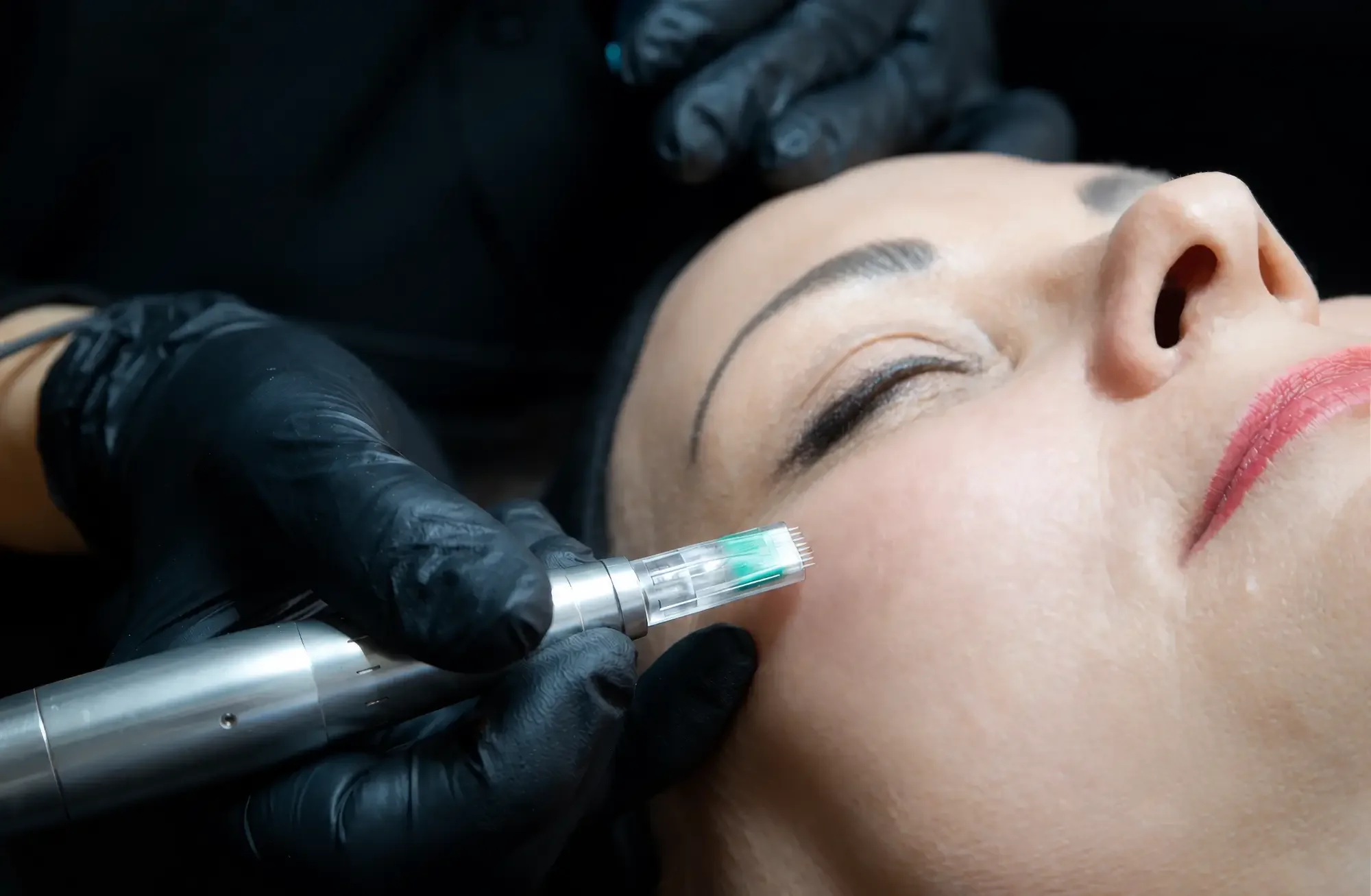 Microneedling