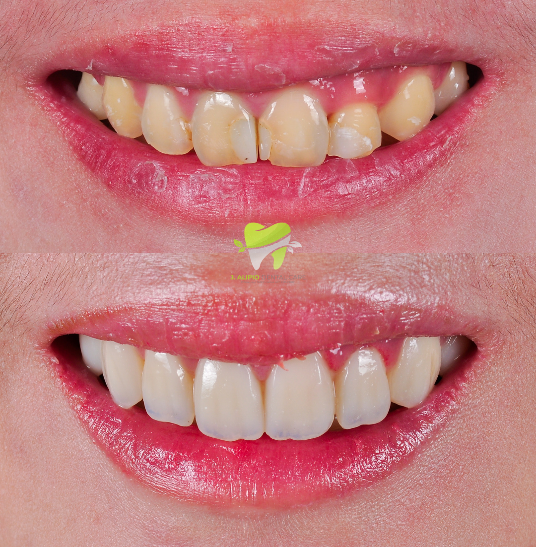Treatment: Direct Composite Veneers and Root Canal Treatment