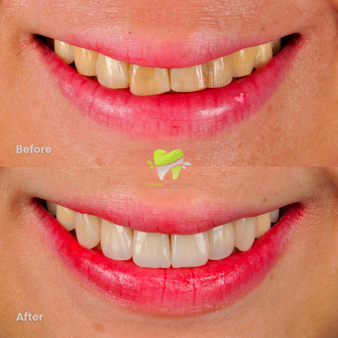 Treatment: Direct Composite Veneers and Root Canal Treatment