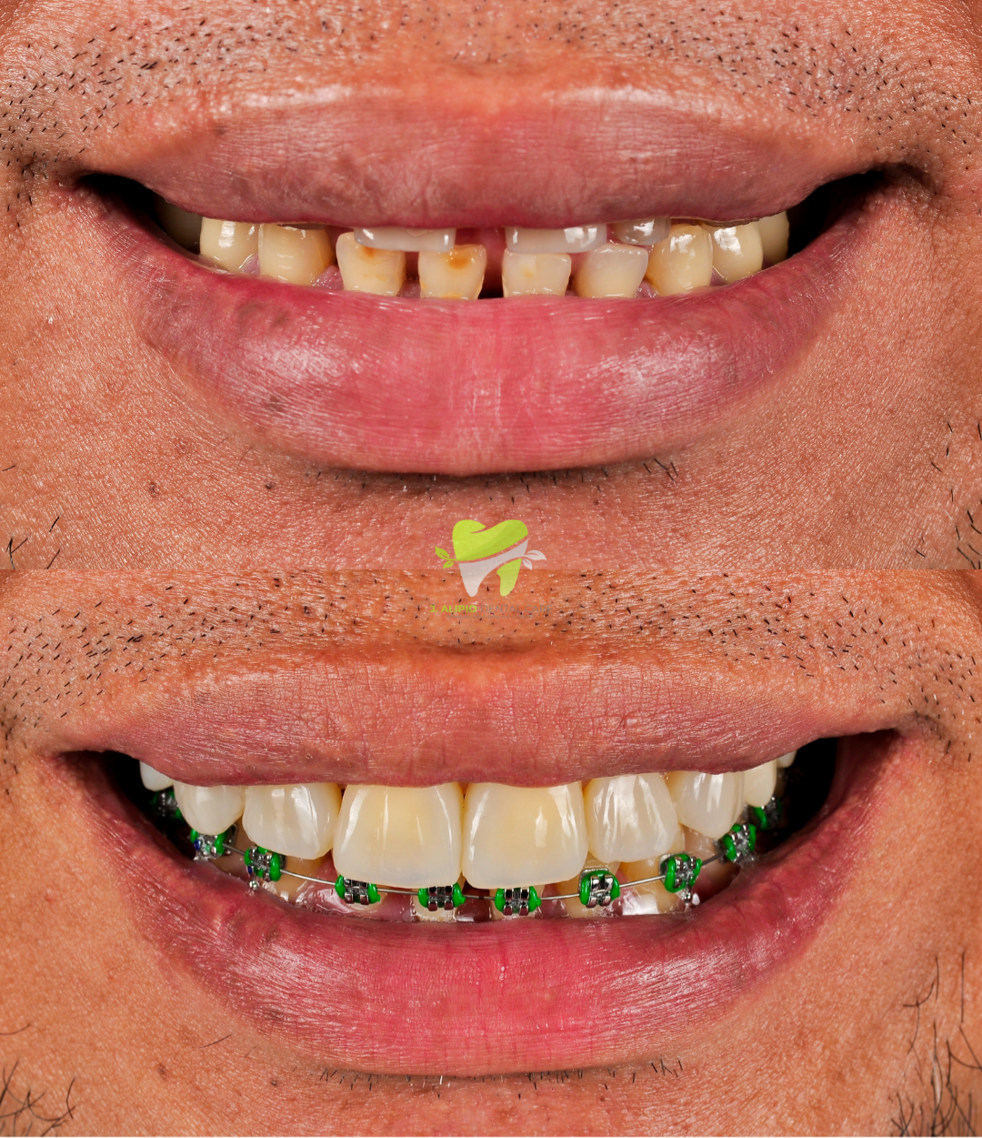Treatment: Direct Composite Veneers