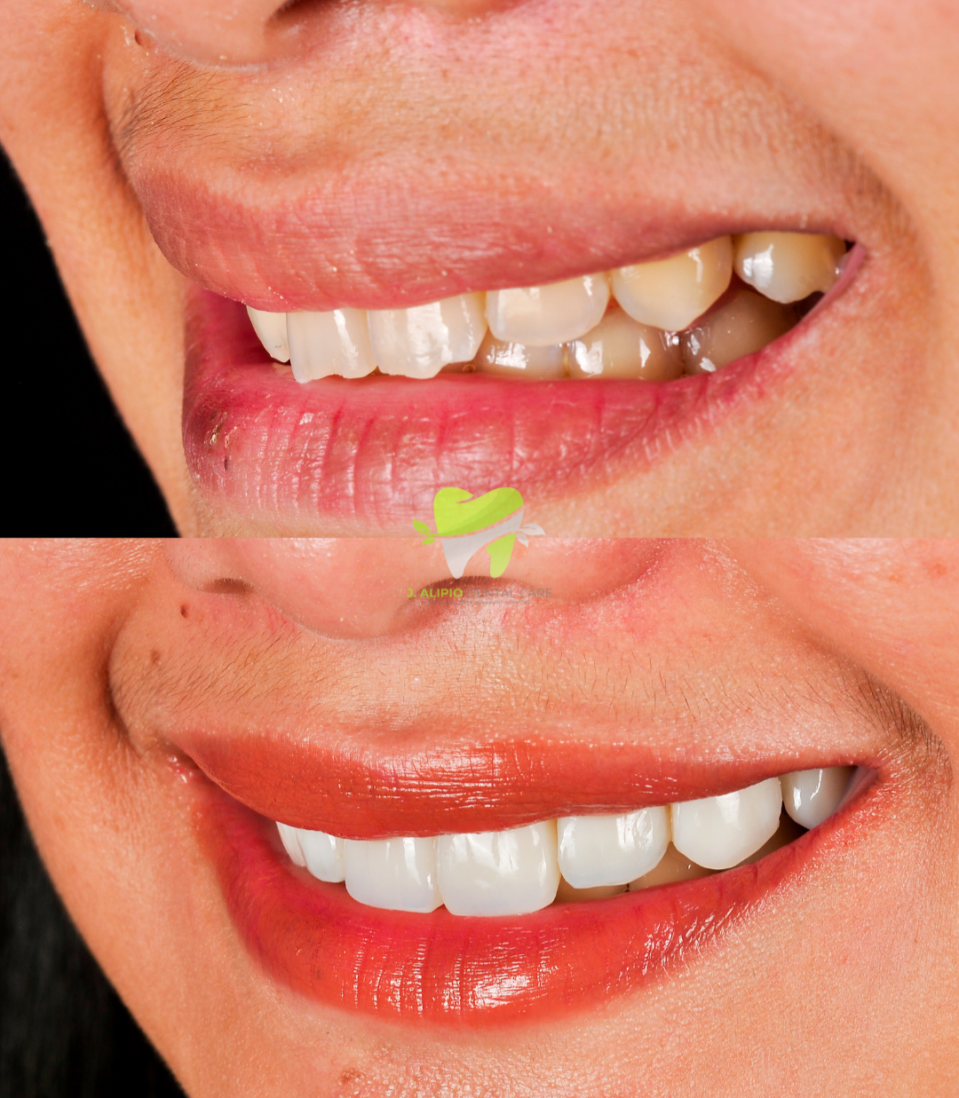 Treatment: Direct Composite Veneers