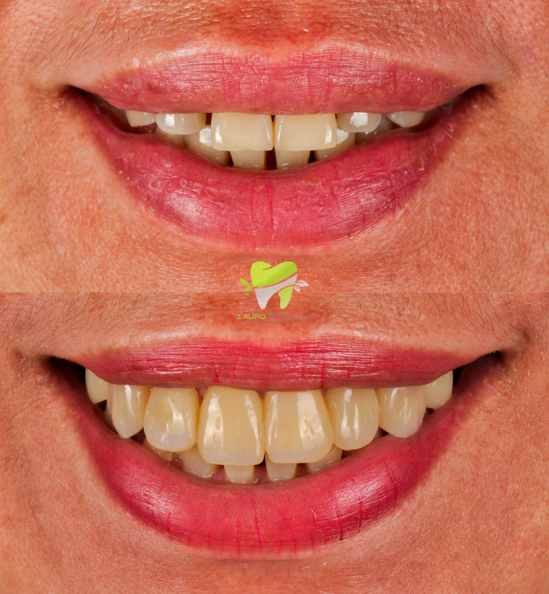 Treatment: Direct Composite Veneers