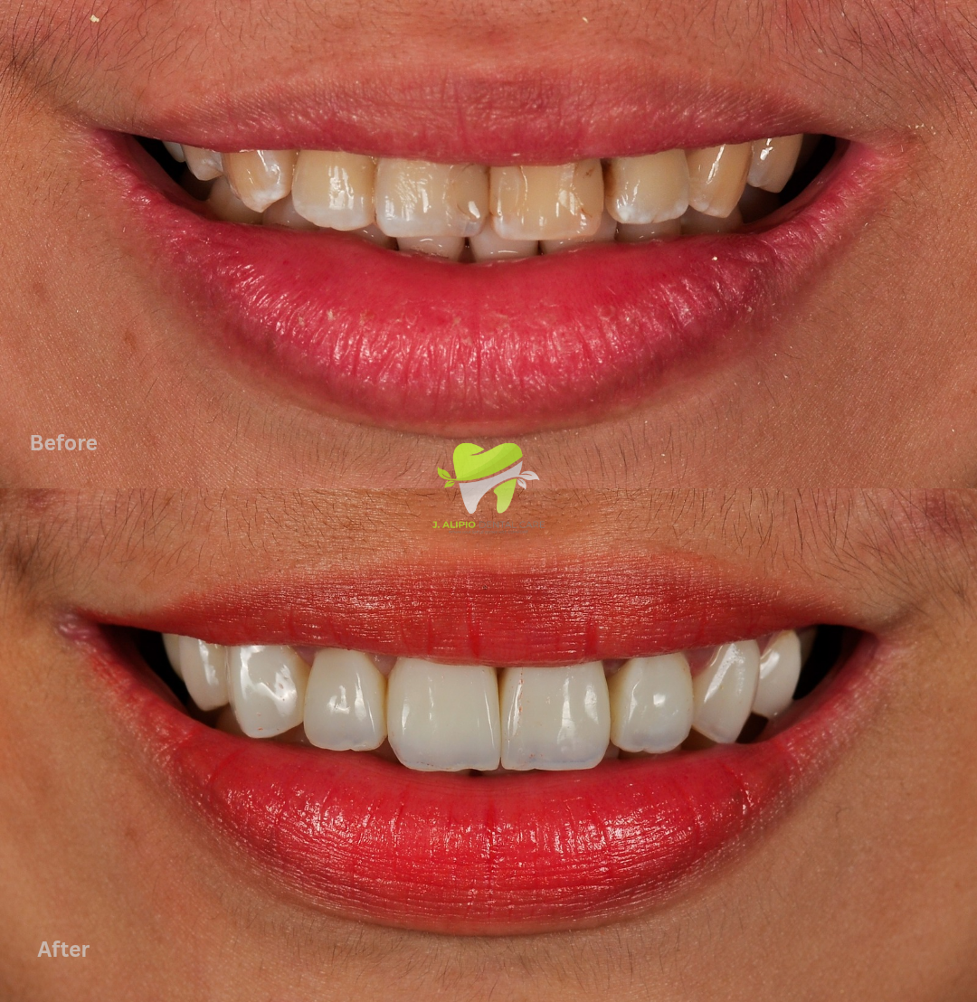 Treatment: Direct Composite Veneers and Root Canal Treatment