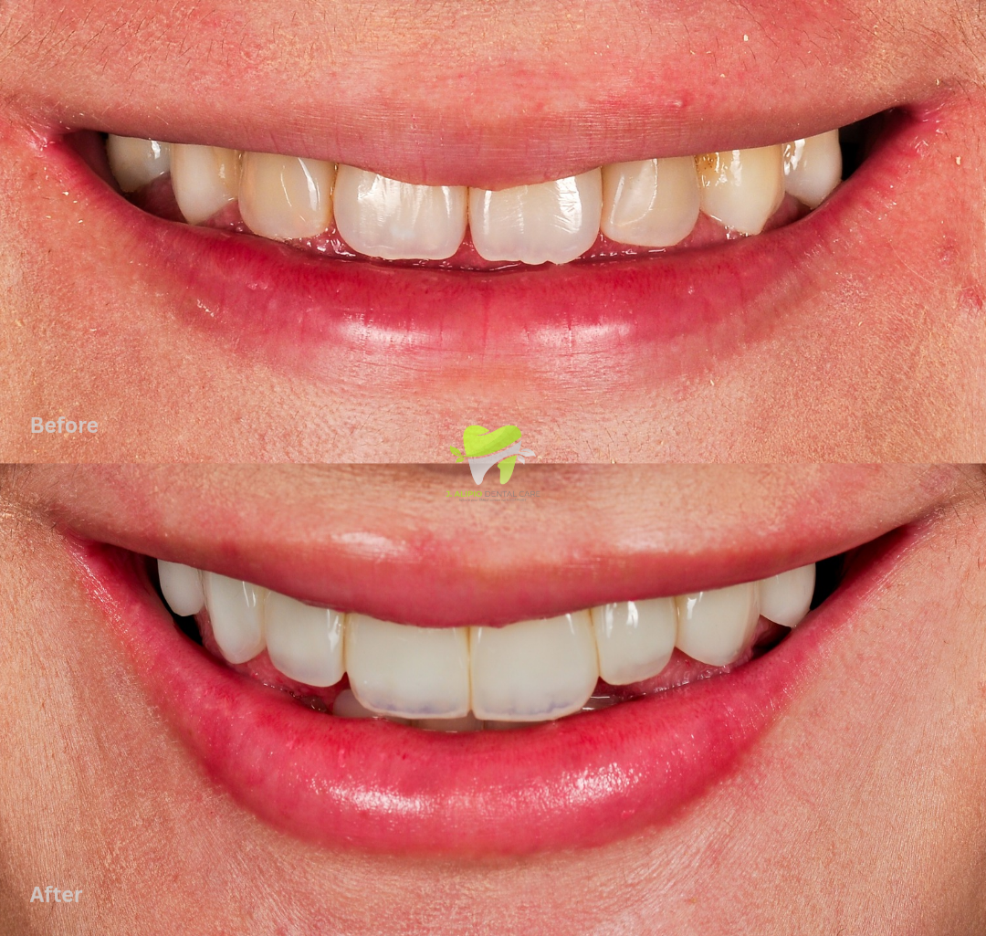 Treatment: Direct Composite Veneers