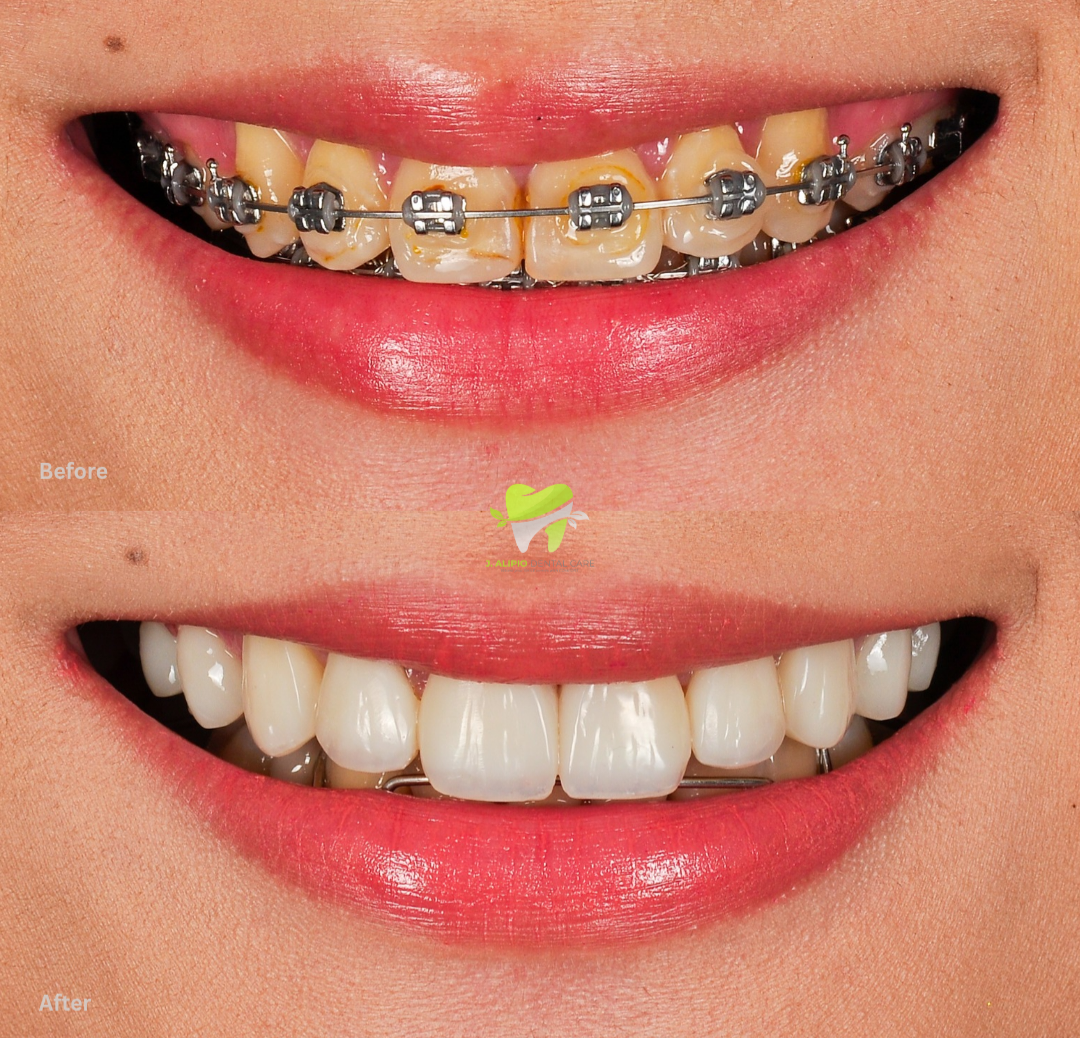 Treatment: Direct Composite Veneers
