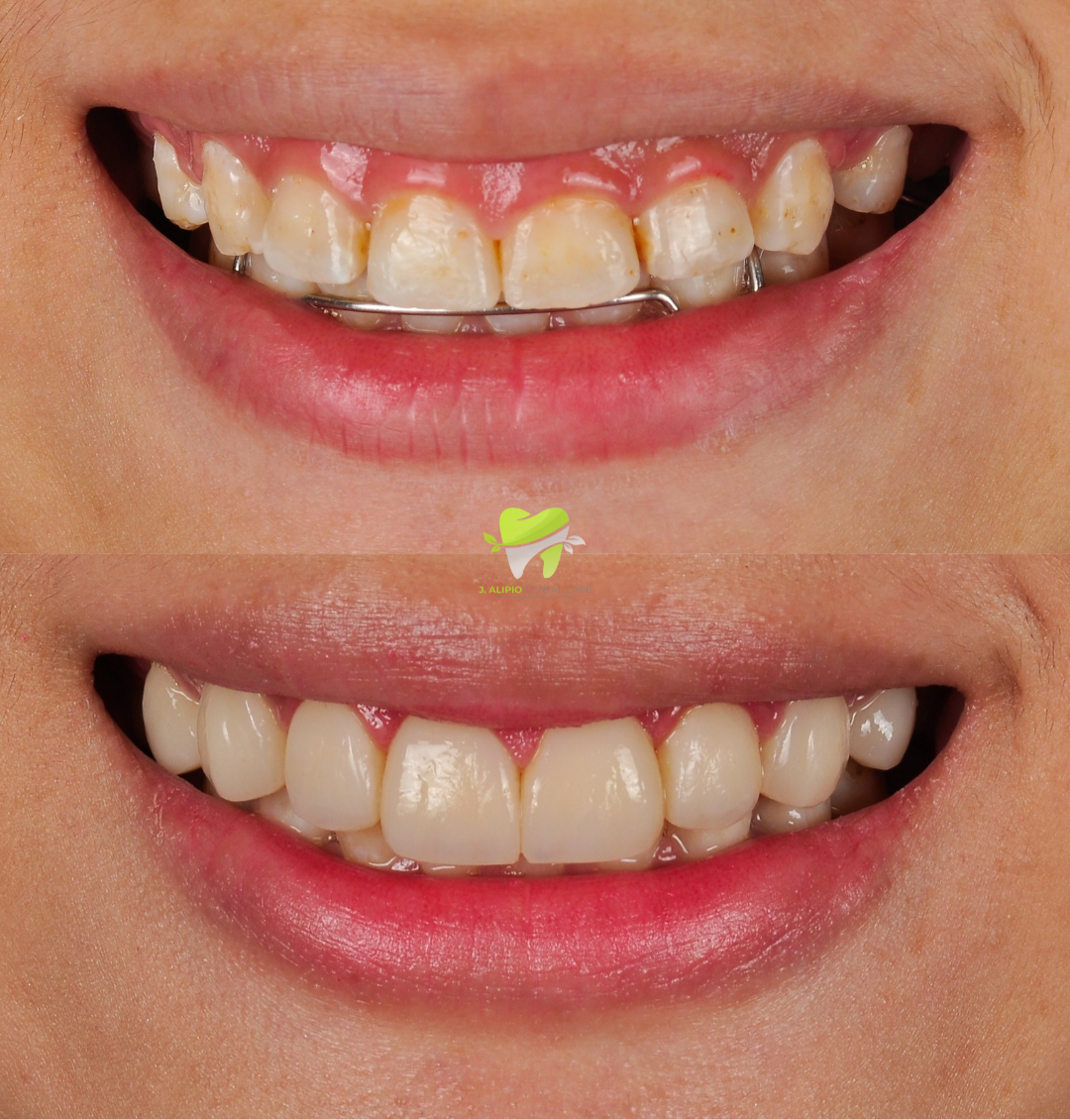 Treatment: Direct Composite Veneers and Gum Contouring
