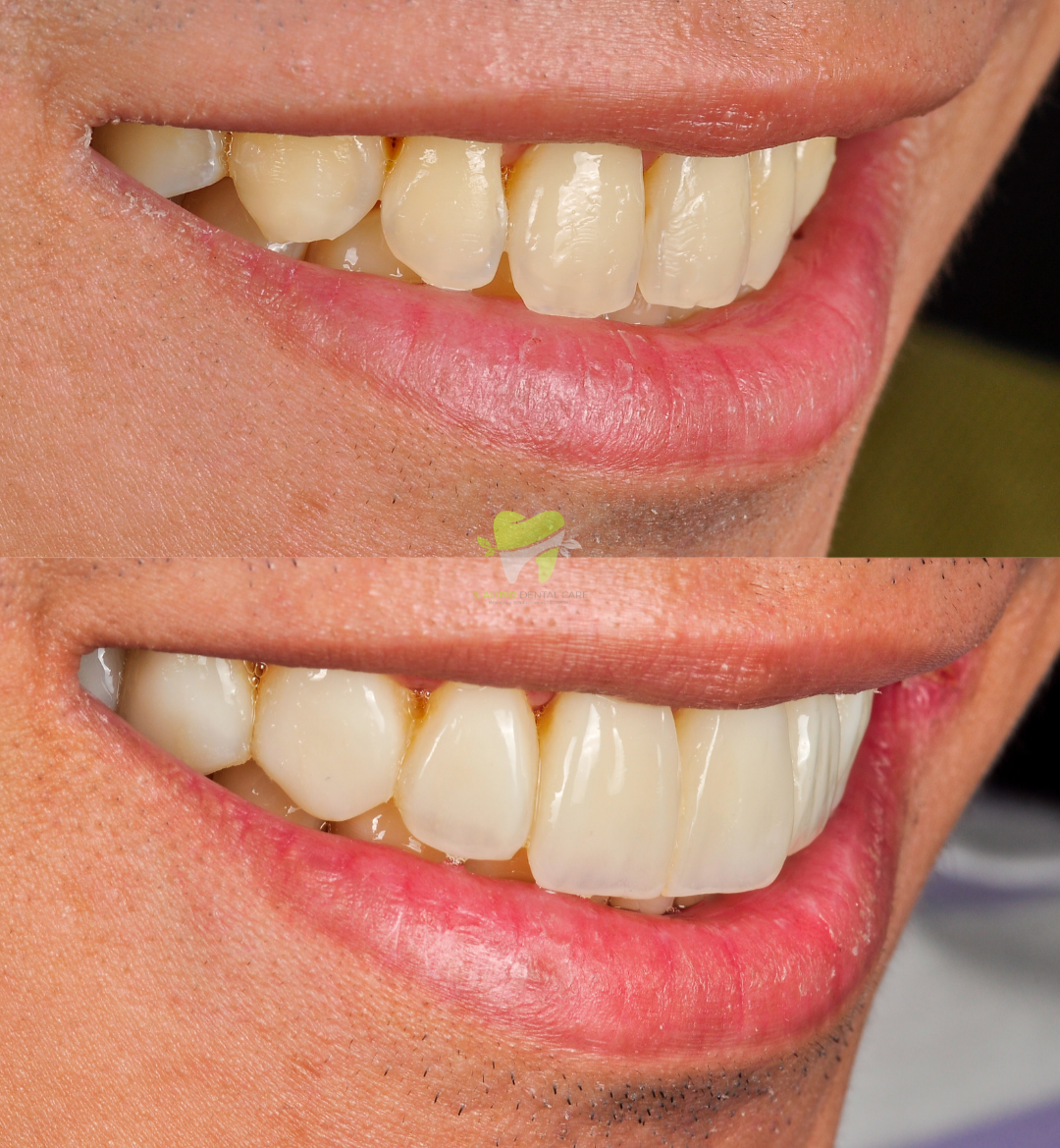 Treatment: Direct Composite Veneers