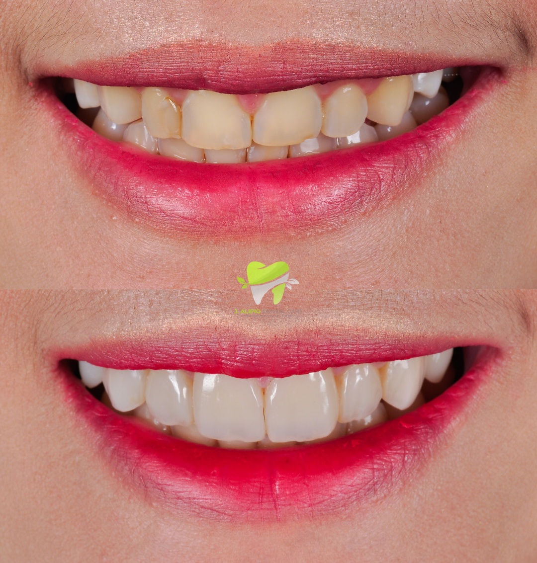 Treatment: Direct Composite Veneers