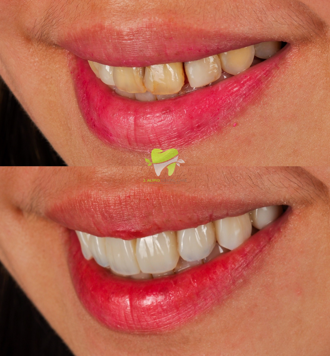Treatment: Direct Composite Veneers and Root Canal Treatment