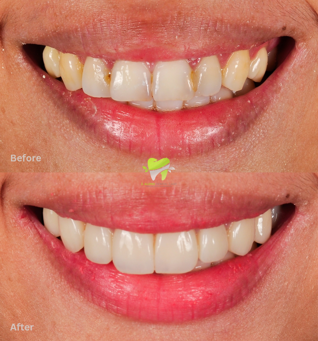 Treatment: Direct Composite Veneers