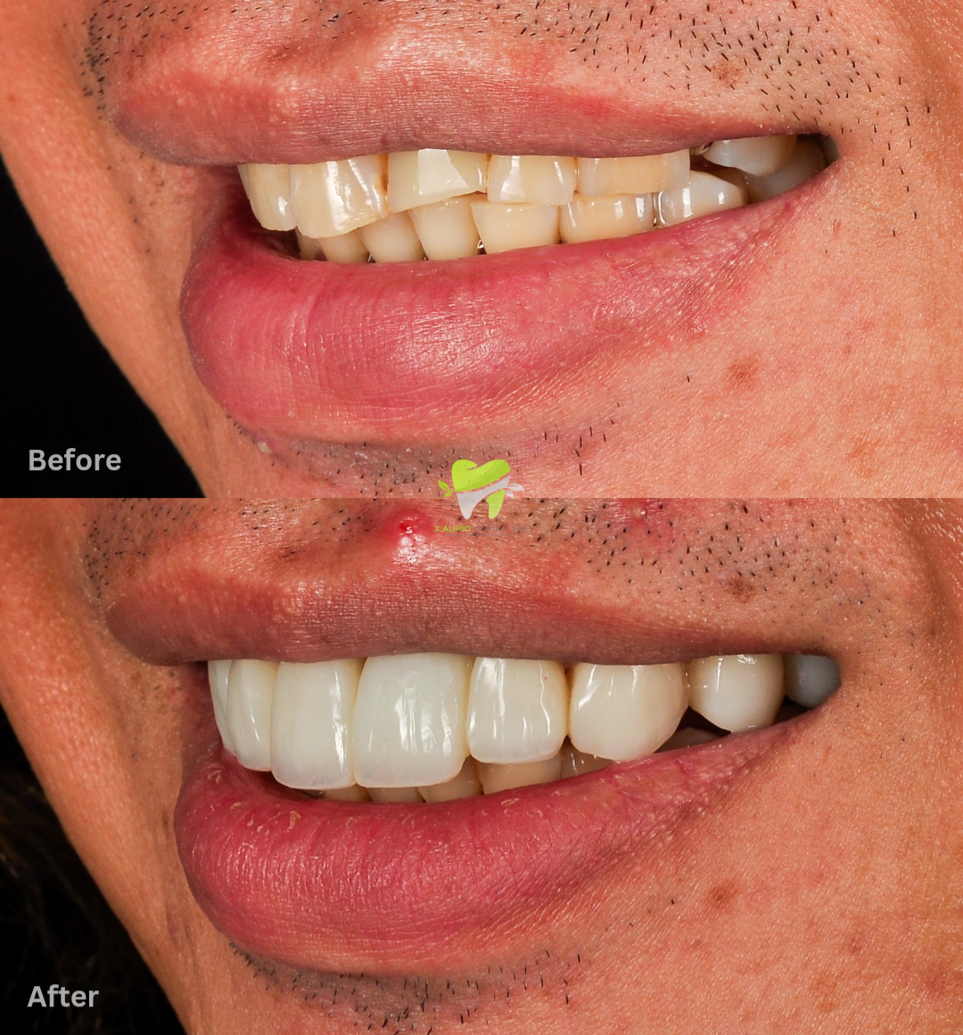 Treatment: Direct Composite Veneers and Fiber reinforced bridge for 1 missing central incisor