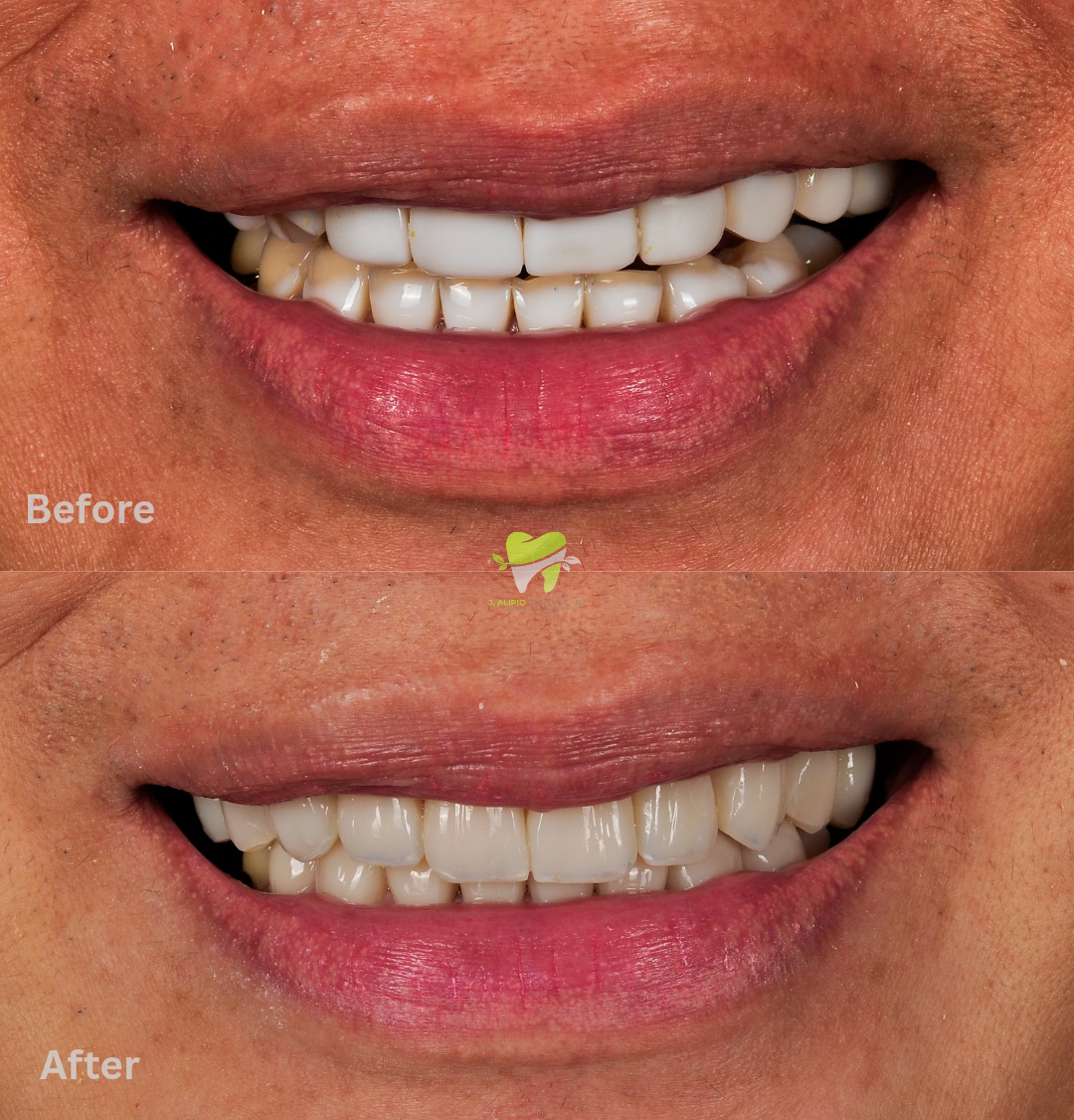 Treatment: Direct Composite Veneers (Replacement of fake looking veneers)