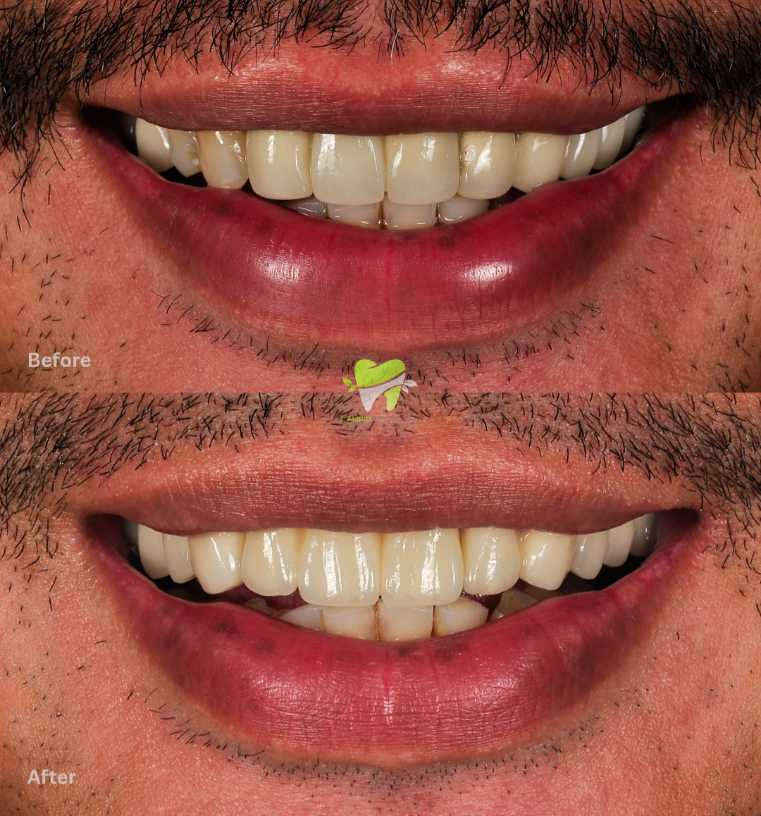 Treatment: Zirconia Fixed Bridge and Veneers