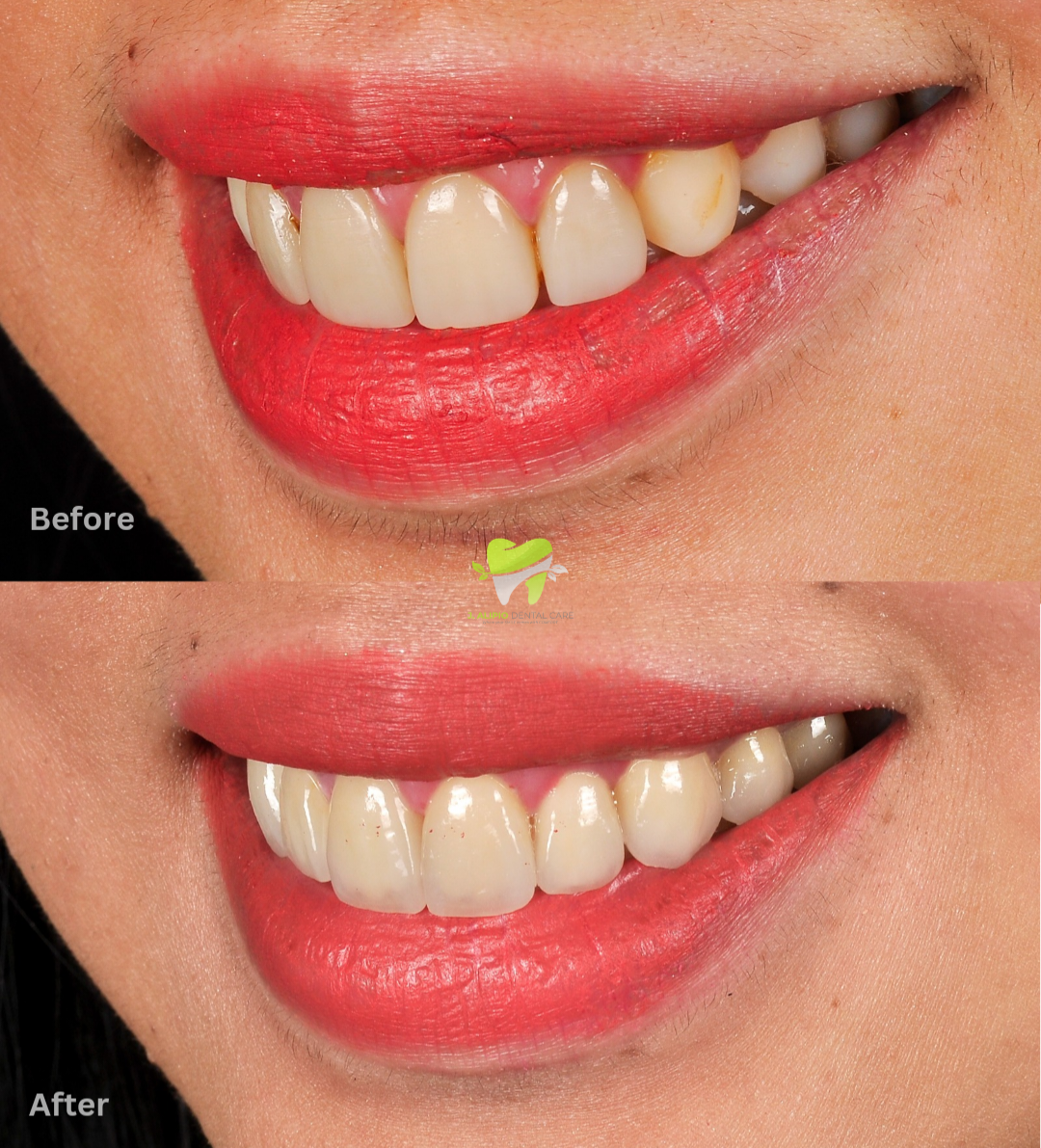 Treatment: Emax (Lithium disilicate) Crowns and Veneers