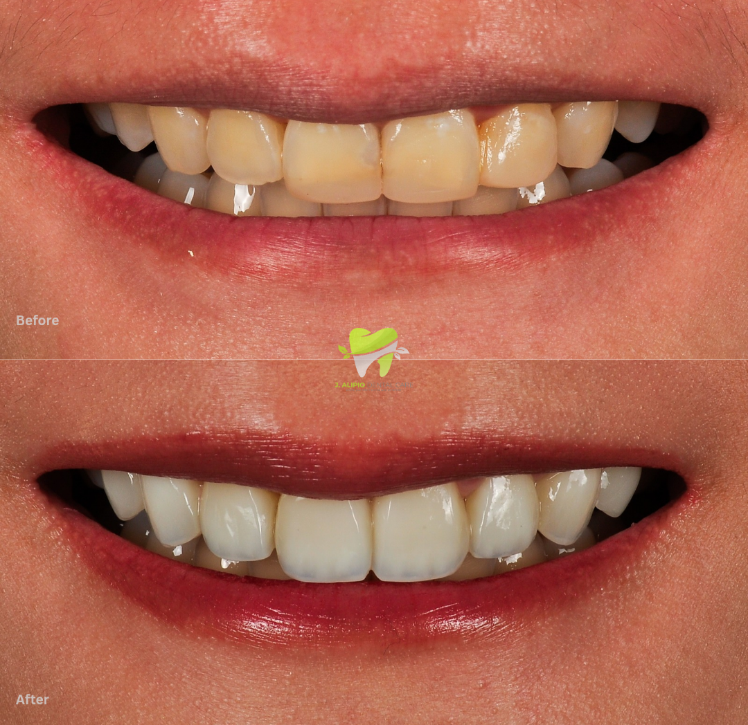 Treatment: Direct Composite Veneers