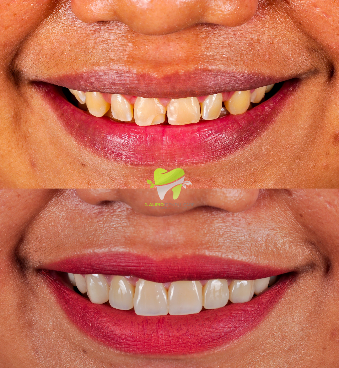 Treatment: Direct Composite Veneers