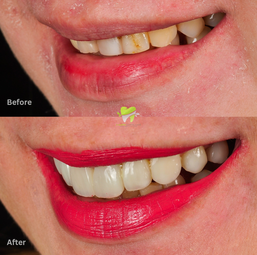 Treatment: Direct Composite Veneers