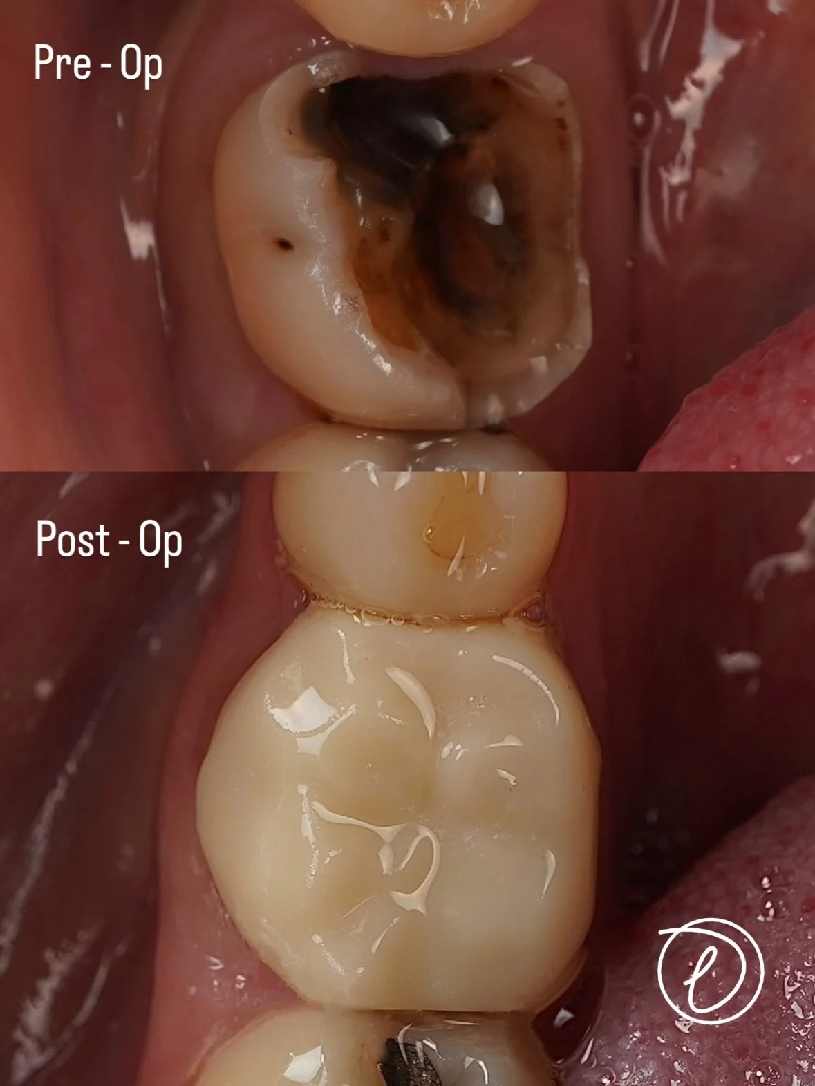 Early Christmas Gift 🎁 

LR6 Ceramic/Zirconia Crown 👑 

&bull; Restorability assessment completed, limited remaining tooth structure &amp; prognosis discussed
&bull; Fractured amalgam removed and secondary caries cleared
&bull; Core build up using 