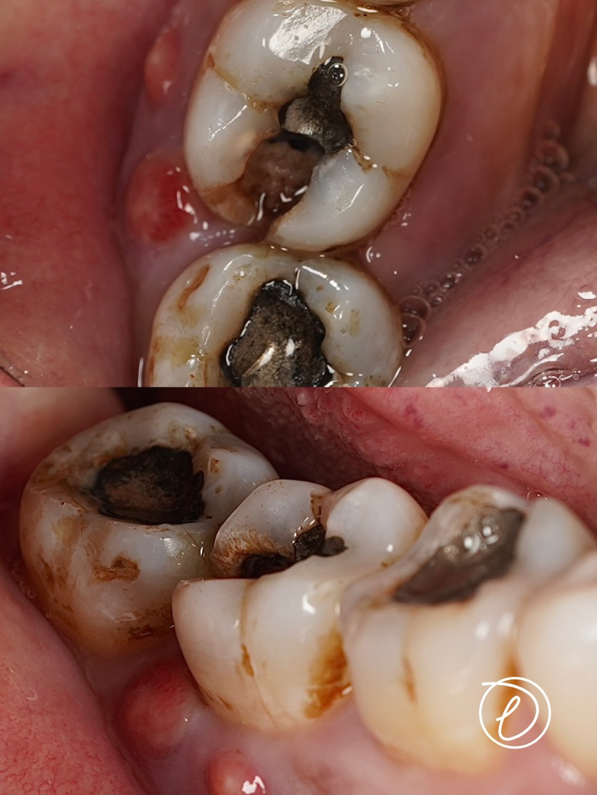 LR6 XLA 🦷💉

&bull; Indication: external root resorption + extensive apical periodontitis
&bull; MH: antiplatelets &rarr; local haemostatic measures🩸
&bull; Technique: luxation &rarr; cowhorn forceps &amp; apical pressure for controlled delivery
&b