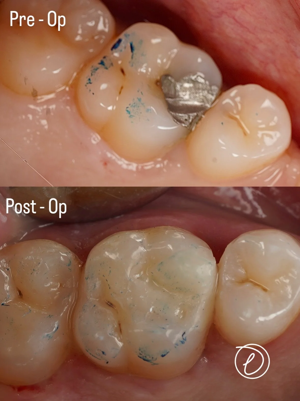 UL6 Established D3 Caries &rarr; Direct Pulp Cap 🫡

🛠️ Clinical Steps:
&bull; Removed defective amalgam
&bull; Cleared caries to ADJ
&bull; Caries &rarr; pulp exposure
&bull; Direct Pulp Cap with Calcium Hydroxide
&bull; Isolated UL6 + Garrison sec