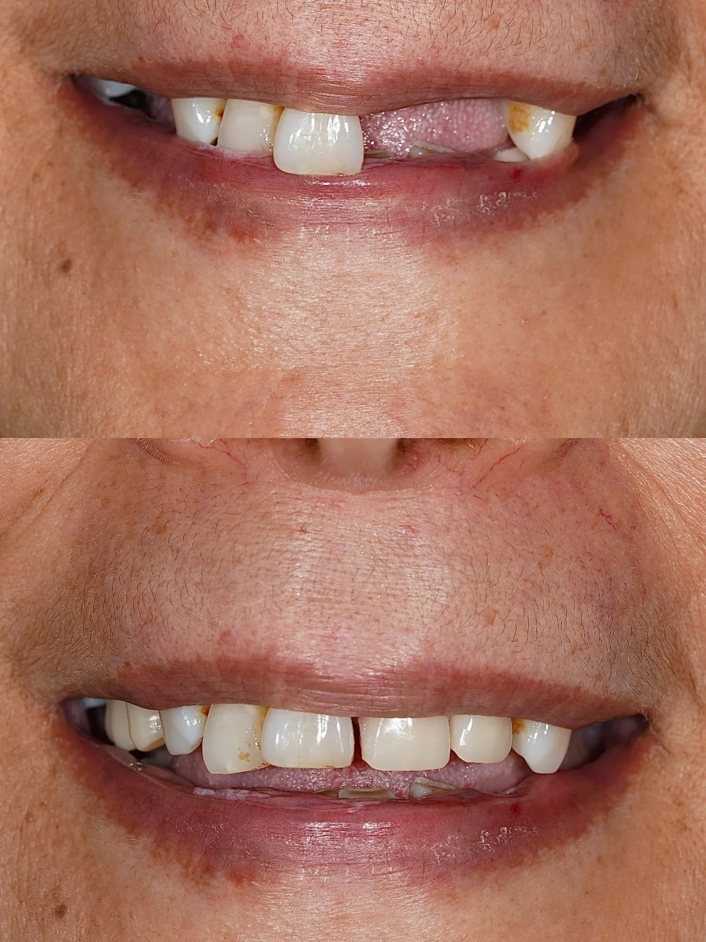 Beautiful result for this patient&rsquo;s Acrylic RPD 🙏

We incorporated natural characterisation using her old smile as reference. Adding her previous diastema to ensure the denture blended seamlessly and felt truly &ldquo;hers.&rdquo; 🫡

This is 