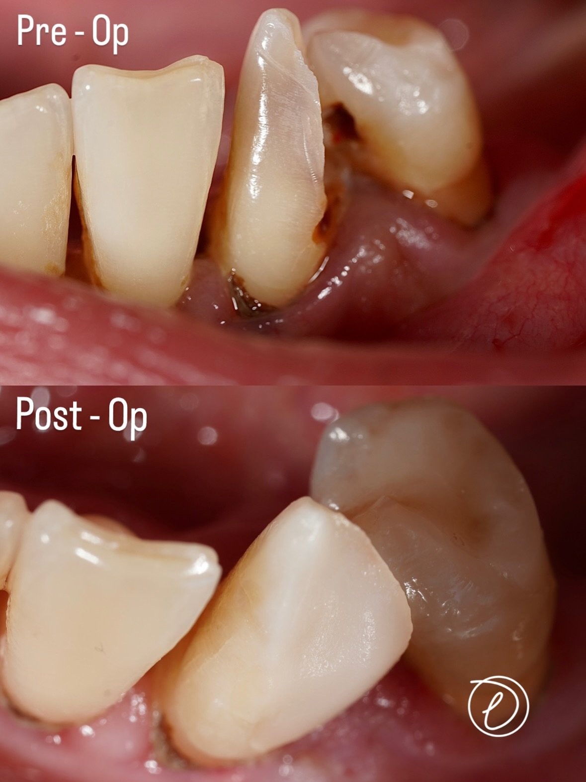 Single Visit RCT on a tilted LL3 😅

When isolation gets tricky, adaptation becomes everything. Different clamps, new angles and a lot of persistence to secure safe isolation. 🗜️

Restoring it was its own challenge: sectional matrices, careful conto