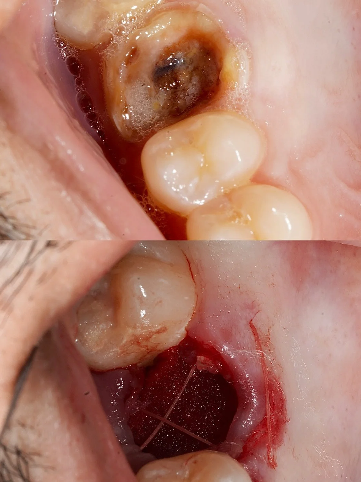 UR6 surgical extraction today. Challenging case that pushed my sectioning and surgical planning skills 👇🦷

Initial sectioning didn&rsquo;t reach the furcation, making root separation difficult. After reassessment, extending the cut further apically