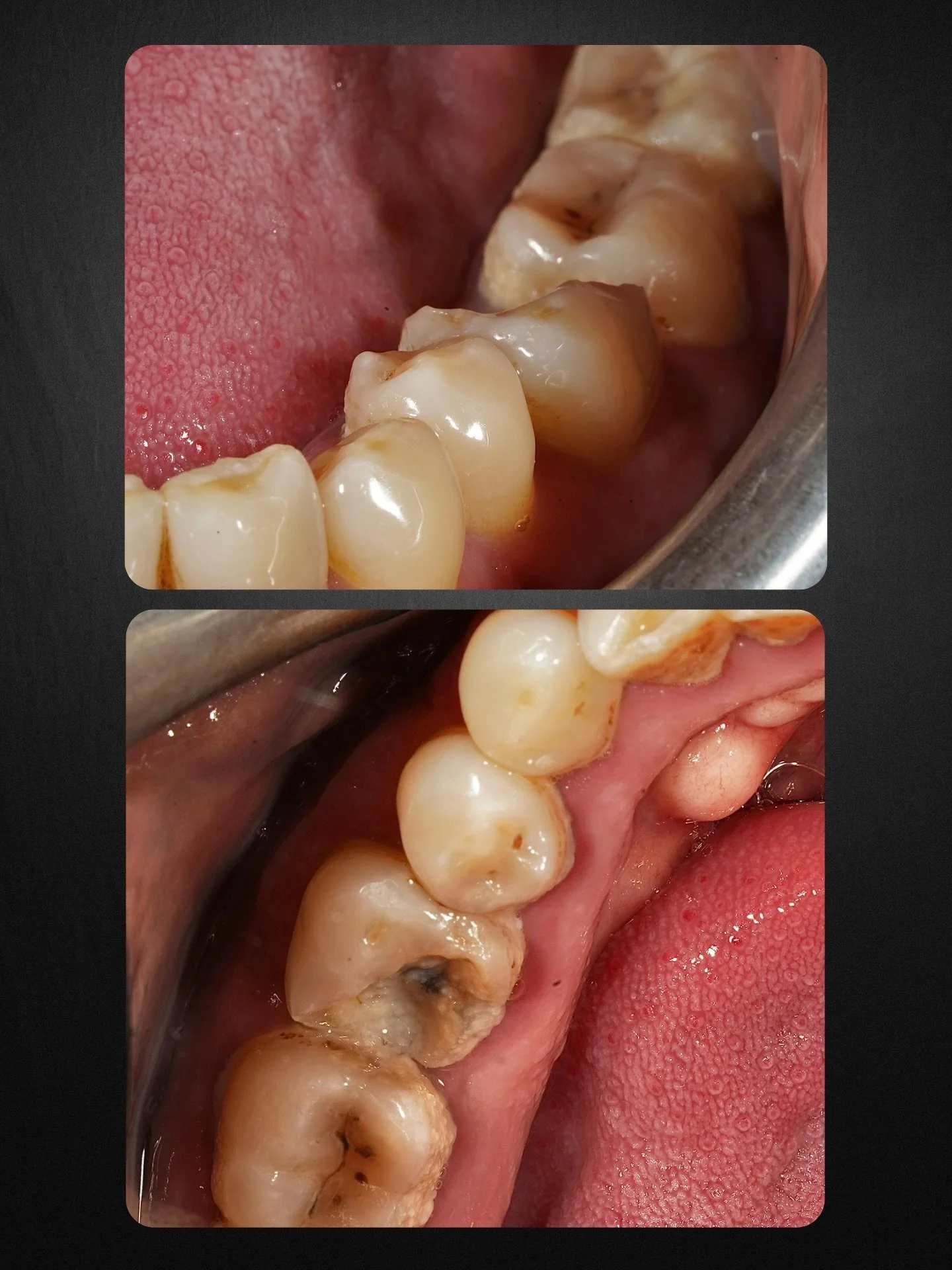 🩸LL6 extraction today - initially suspected to require a surgical approach due to limited mobility, dense bone, and complex anatomy.

After initial luxation, elevation and lower molar forceps, resistance suggested poor mechanical advantage. On reass