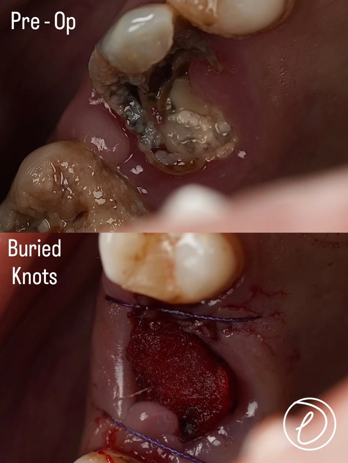 UR6 XLA &amp; Buried Surgical Knots 🦷🪡

&bull; Grossly carious UR6 &rarr; terminal prognosis
&bull; Patient: antiplatelets + anxiety medication, special care needs
&bull; Careful planning with local haemostatic measures
&bull; Buried suture techniq