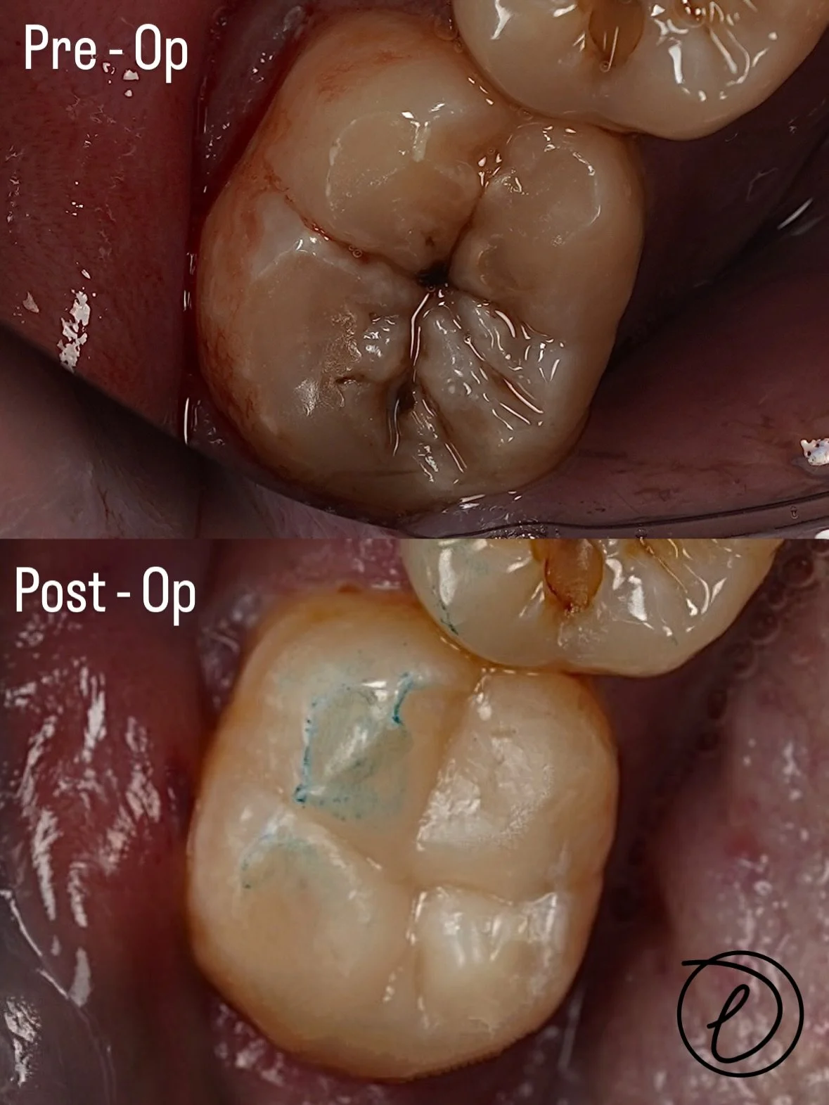 Direct Composite Restoration (LR7) 🦷 

Assessment 📕 
&bull; Pre-op occlusal analysis to guide anatomy &amp; contacts

Preparation 🔨 
&bull; Caries removal with focus on the Peripheral Seal Zone
&bull; Resin coating placed at the base for protectio