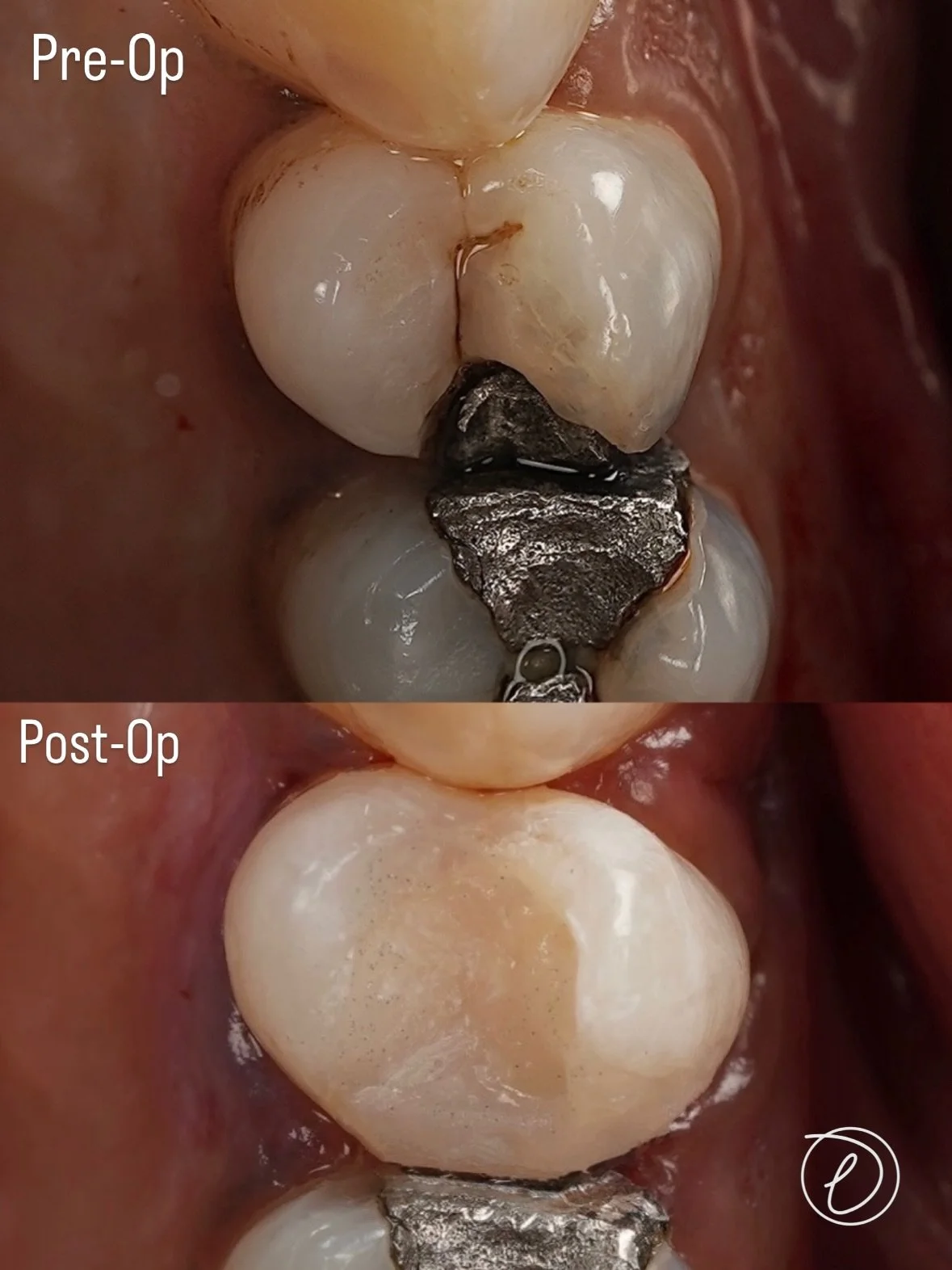 UR5 RCT &amp; Sealer Puff 🦷😎

. Removal of defective amalgam restoration
. Initial access achieved
. Rubber dam isolation placed
. Pre Endo build up completed

⚠️ Matrix challenge
&bull; Irregular contact point made sectional matrix placement diffi