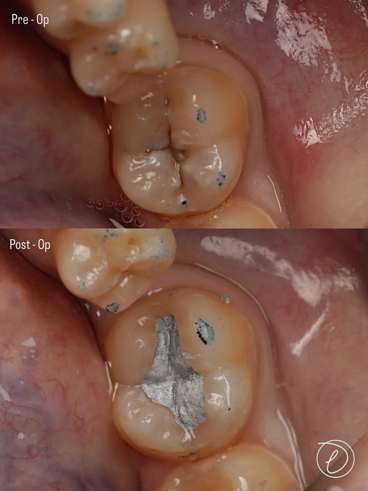 LL7 Class I Amalgam 

Back to basics 🤷&zwj;♂️. Stabalisation phase = 🍞 &amp; 🧈 Dentistry 

🥣 Assessment
&bull; Deep fissures with caries risk linked to diet
&bull; Diet advice and preventive measures reinforced prior to restoration

🔎 Pre operat