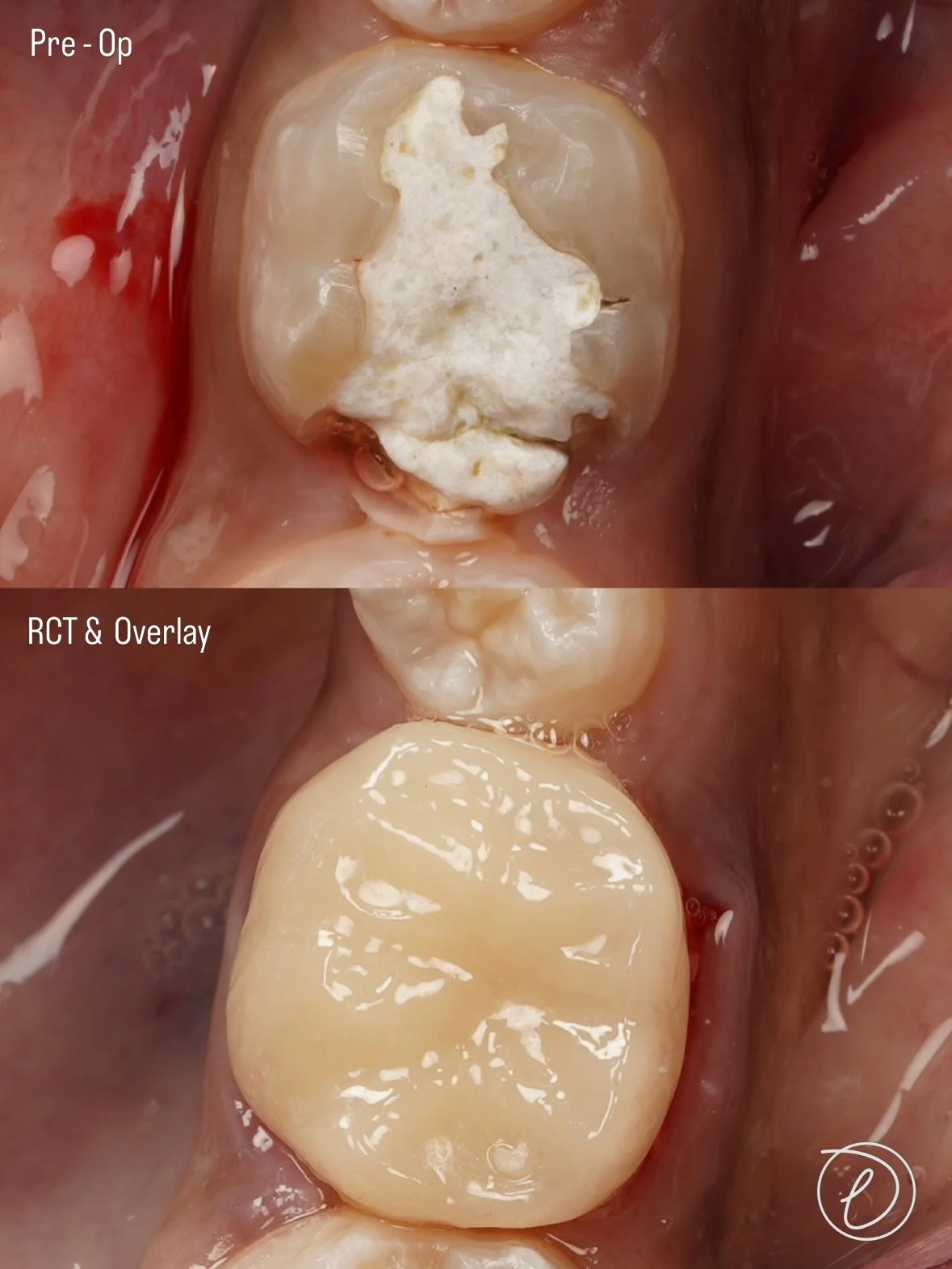 LR6 | RCT &amp; E.max Overlay with Heated Composite Protocol 🦷

🔎 Diagnosis &amp; planning
&bull; Symptomatic tooth indicated for root canal treatment followed by cuspal coverage
&bull; Plan for lithium disilicate (E.max) overlay to restore strengt