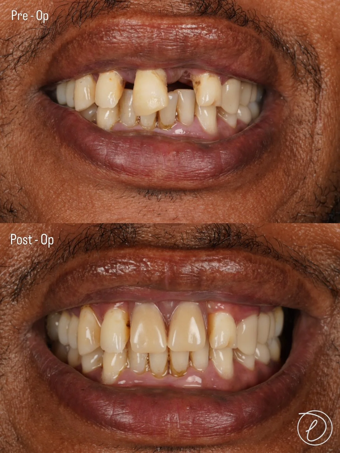 UR1 XLA &amp; Immediate Denture 🦷

🔎 Assessment &amp; diagnosis
&bull; Generalised Periodontitis, Stage 3, Grade B 
&bull; UR1 deemed terminal prognosis with Grade 3 Mobility
&bull; Heavy emphasis on oral hygiene improvement and patient motivation

