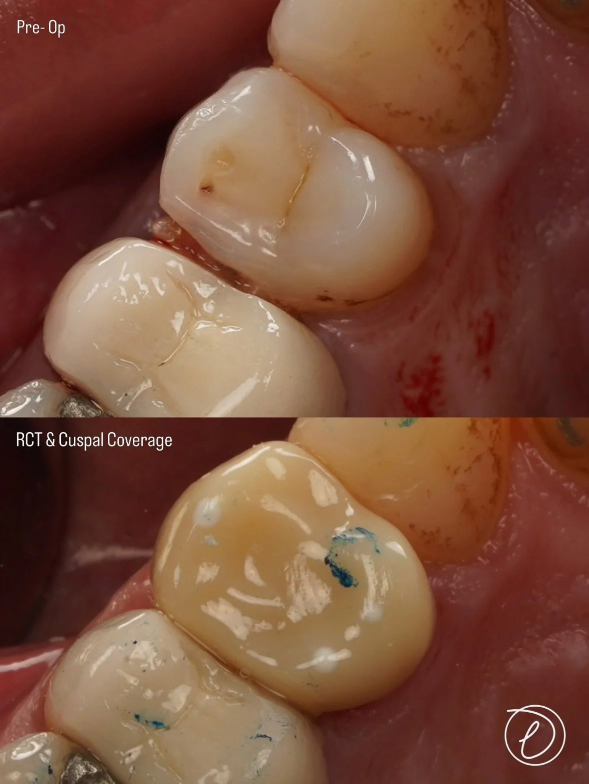 UL4 RCT ➝ Zirconia Crown 🦷

🔎 Assessment &amp; planning
&bull; Pre operative occlusal assessment 
&bull; Caries removal &amp; restorability assessment carried out prior to treatment
&bull; Pre endodontic build up (creating a reservoir for 2% sodium