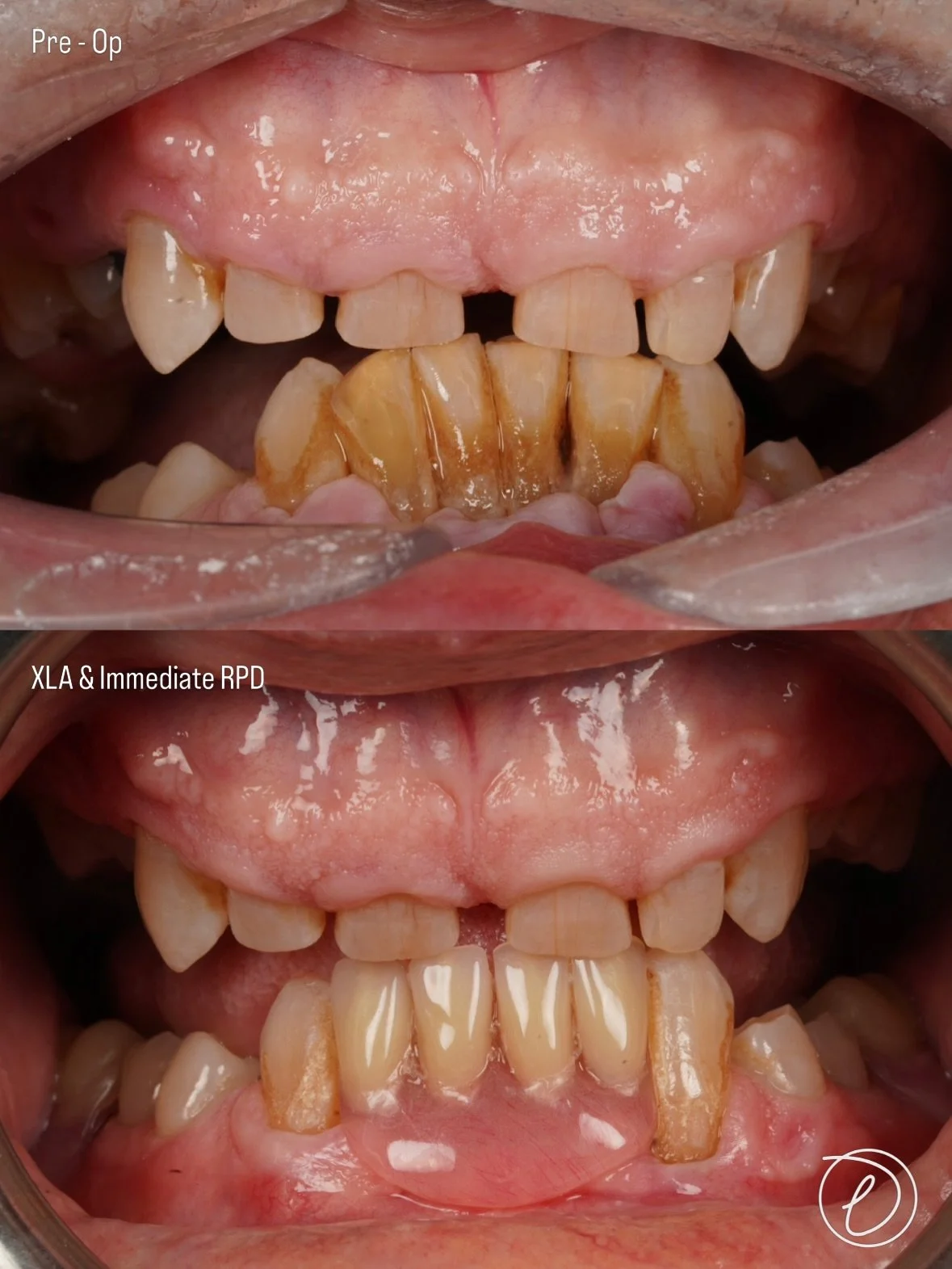 XLA &amp; Immediate Acrylic RPD 🩸 

🩺 Clinical Presentation

 - Severe gingival hyperplasia and inflammation secondary to systemic calcium channel blockers.
 - Mandibular anterior teeth (LL2 - LR2) Periodontally affected with Grade 2 Mobility 
 - D