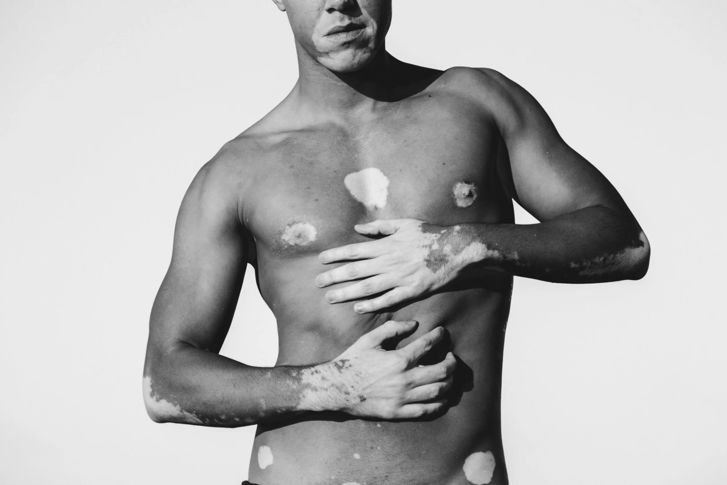 Black and white portrait of Vitor Maccla, musician and vitiligo awareness spokesperson, photographed during an intimate portrait session.
