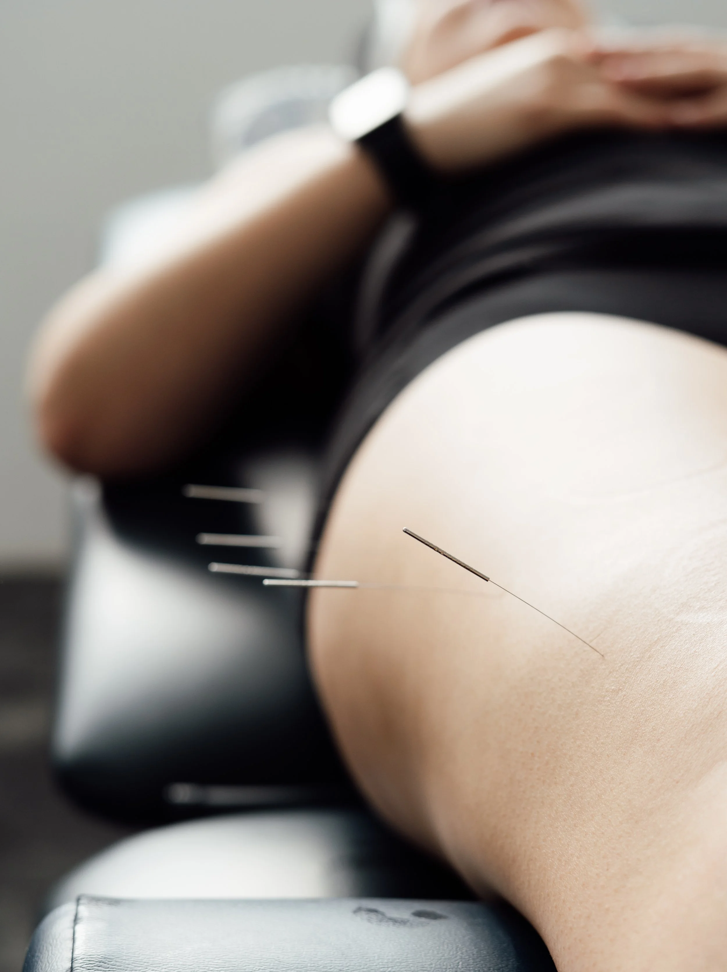 Close-up of a person receiving acupuncture treatment, with acupuncture needles inserted into their skin on their arm. The person is lying on a treatment table with a gray surface.
