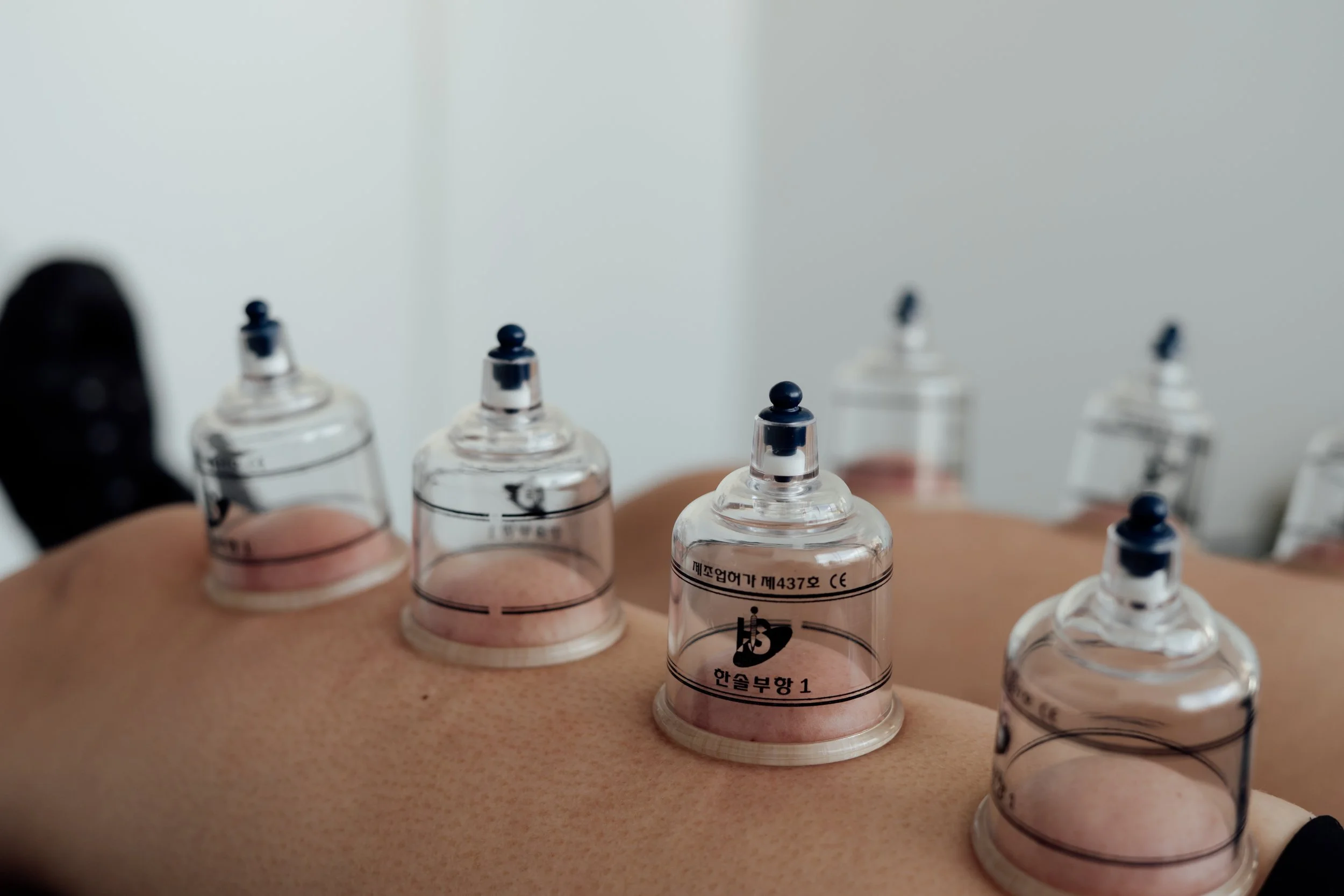 Multiple medical syringes with black plungers and clear barrels filled with liquid resting on a person's back, likely during acupuncture treatment.