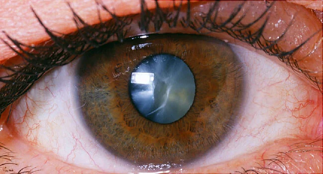 cataract.jpg