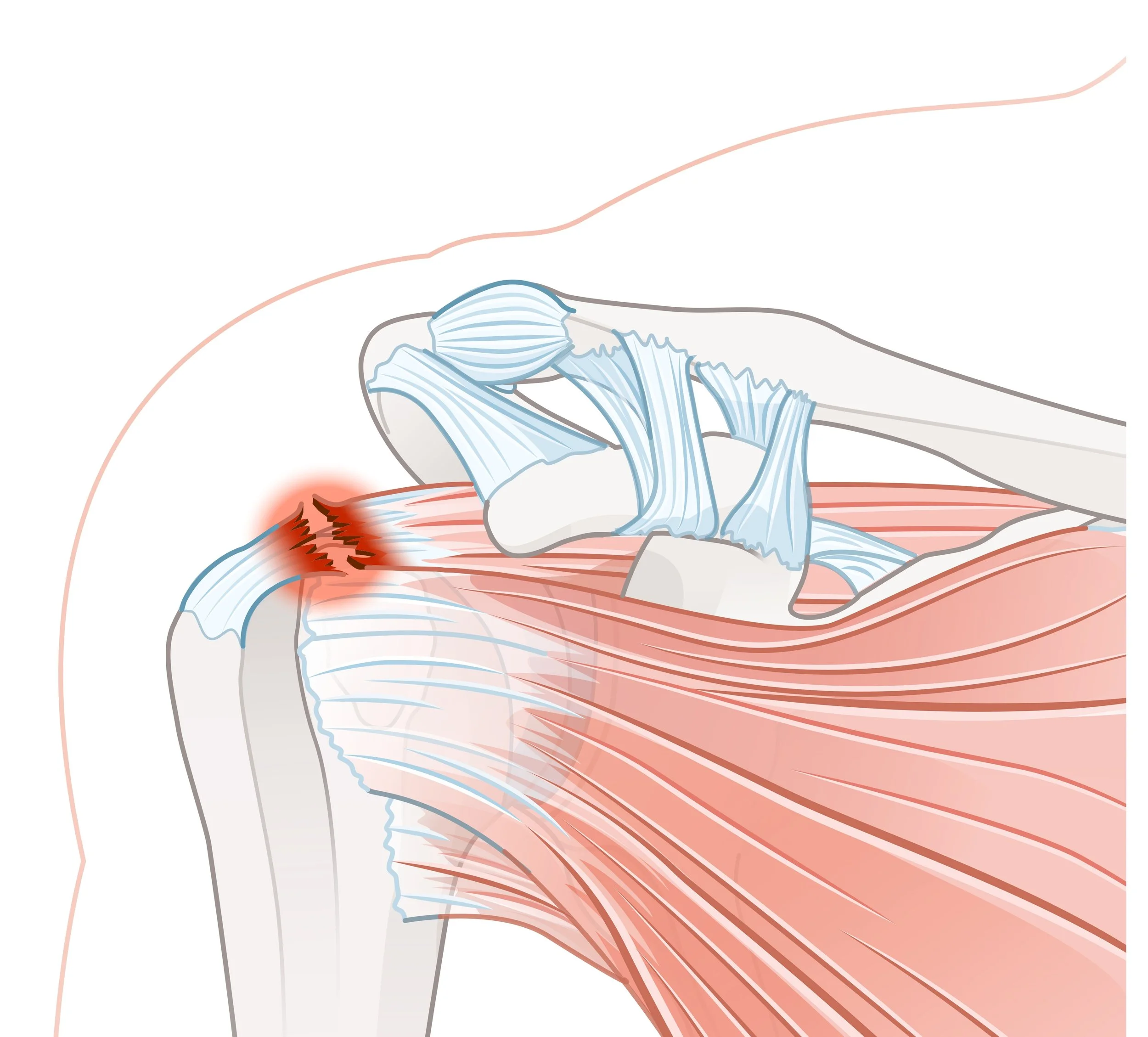 Illustration of shoulder muscles and tendons, highlighting a shoulder injury with inflammation and pain.