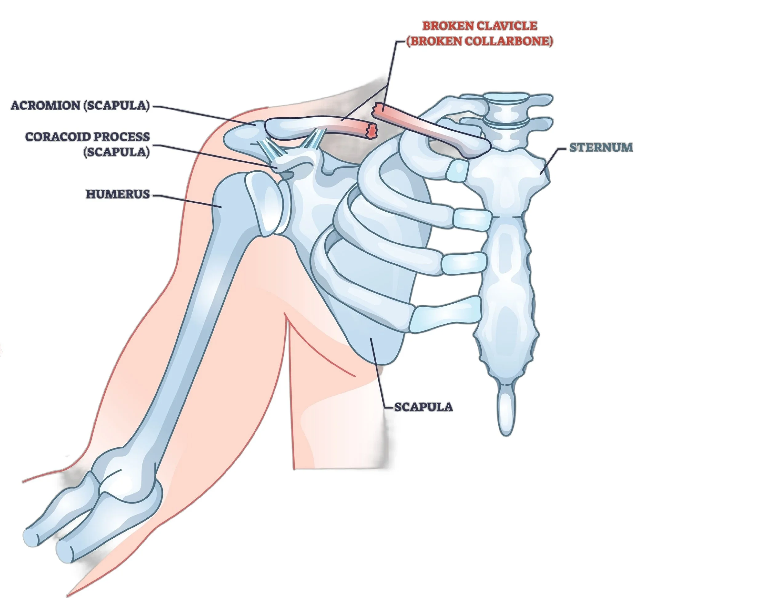 An illustration of a broken clavicle bone on an image showing the scapula, humerus, and ribs, with labels for the acromion, coracoid process, scapula, sternum, and a fracture in the clavicle. - Dr. Kevin Wall, Richmond, VA