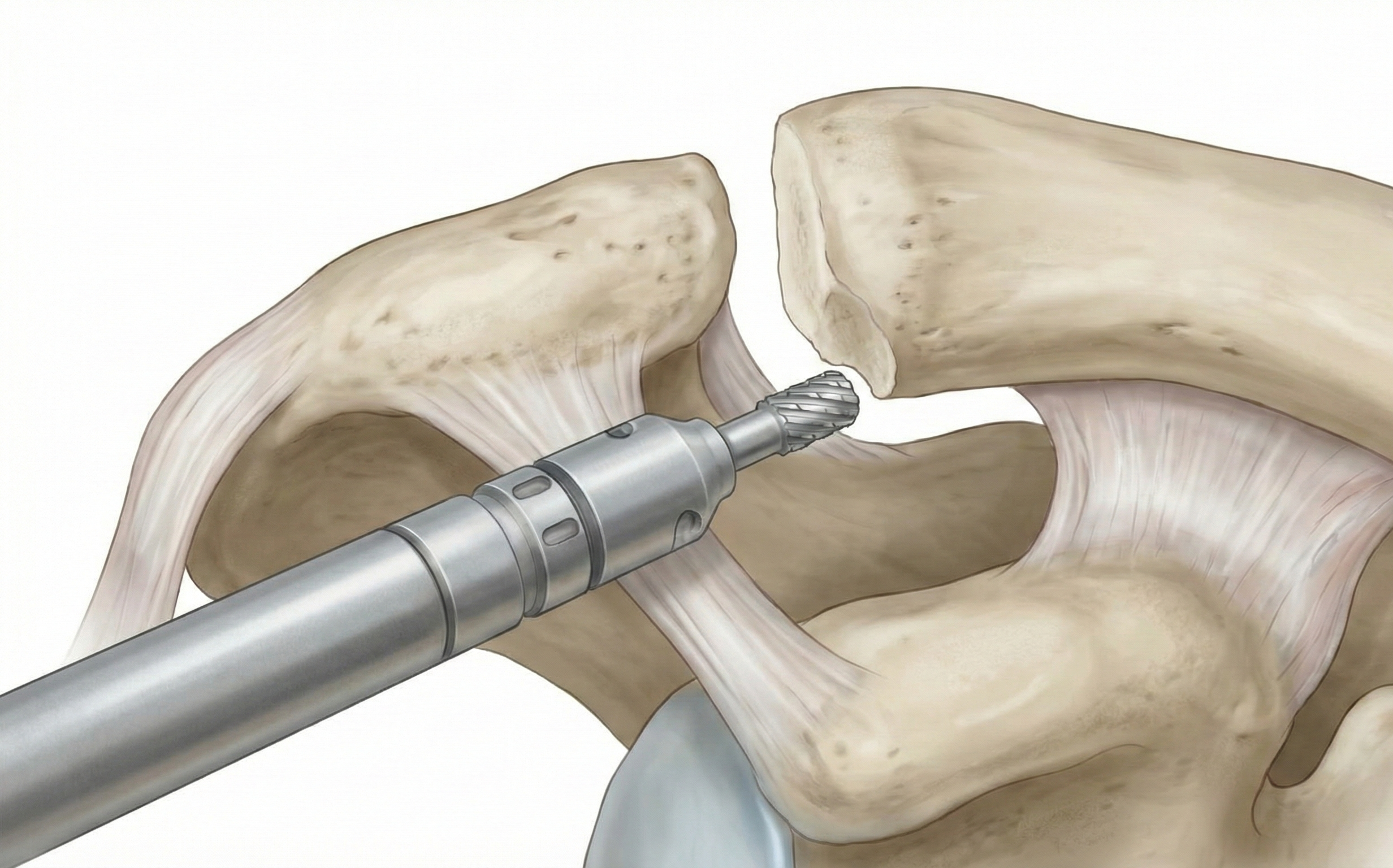 Medical illustration of an arthroscopic distal clavicle excision. - Dr. Kevin Wall, Richmond, VA