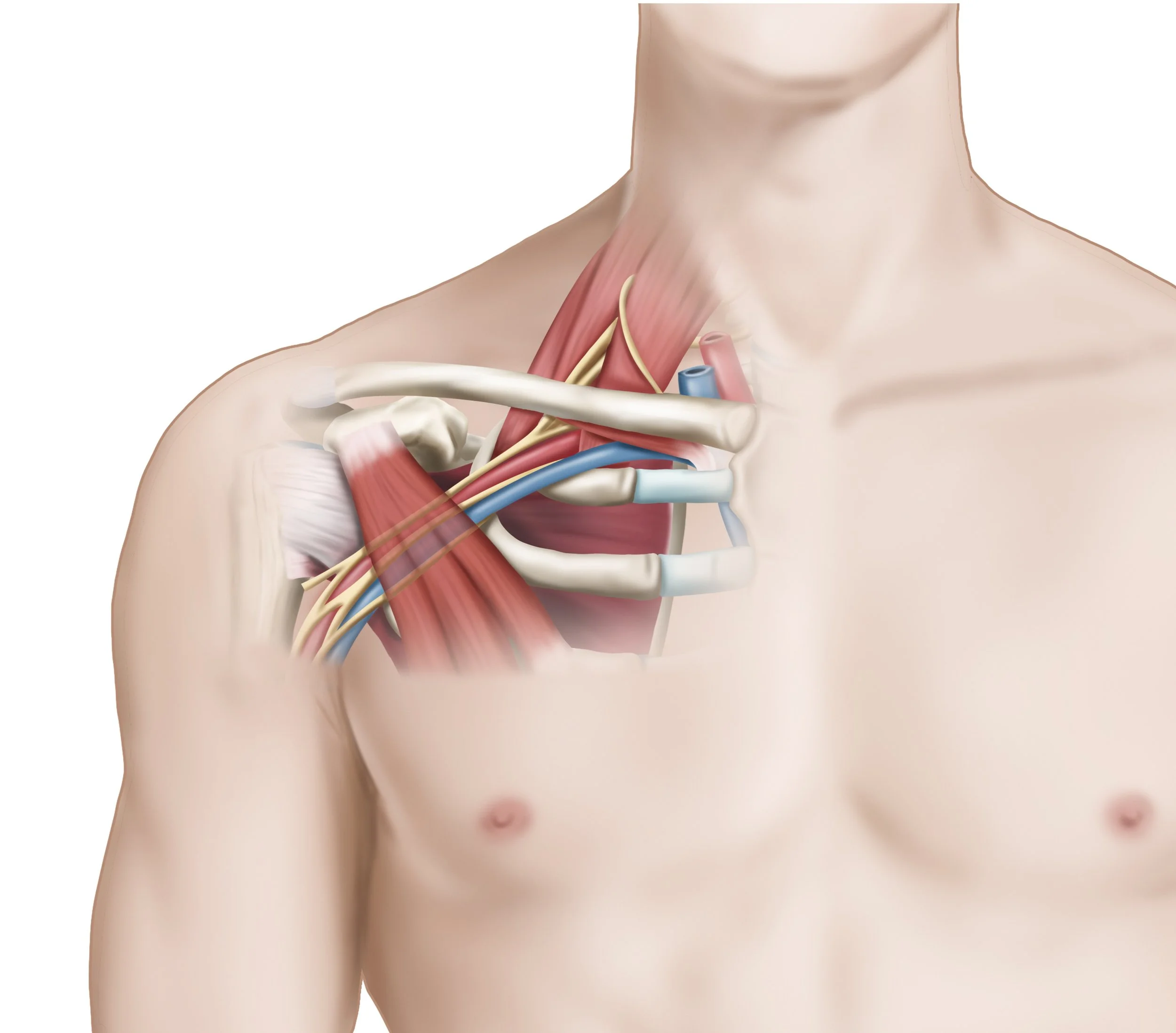 Anatomical illustration of the shoulder showing muscles, tendons, and nerves. The pectoralis minor is shown over the brachial plexus and thoracic outlet. - Dr. Kevin Wall, Richmond, VA