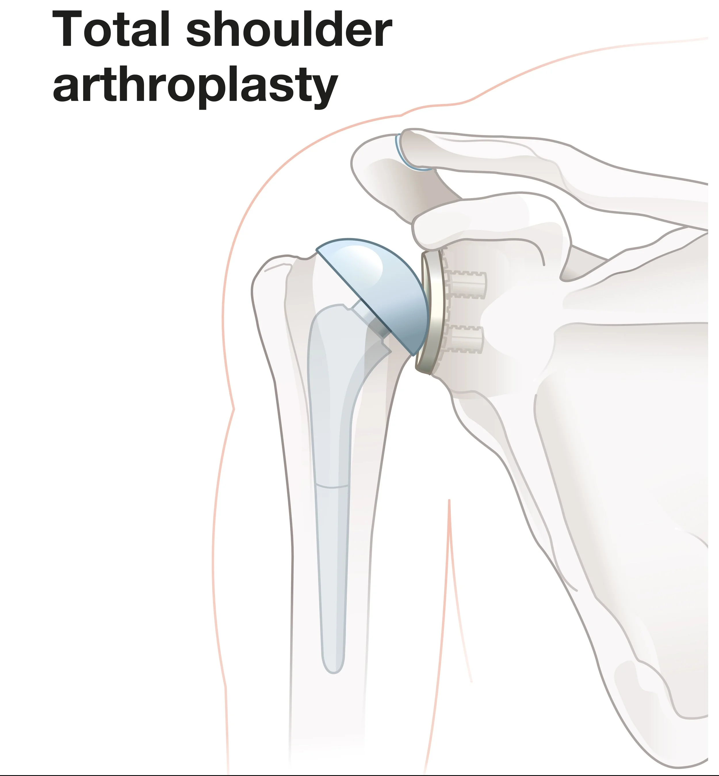 Diagram of a total shoulder arthroplasty, showing a prosthetic ball and socket fitted into the shoulder joint with the arm bone.